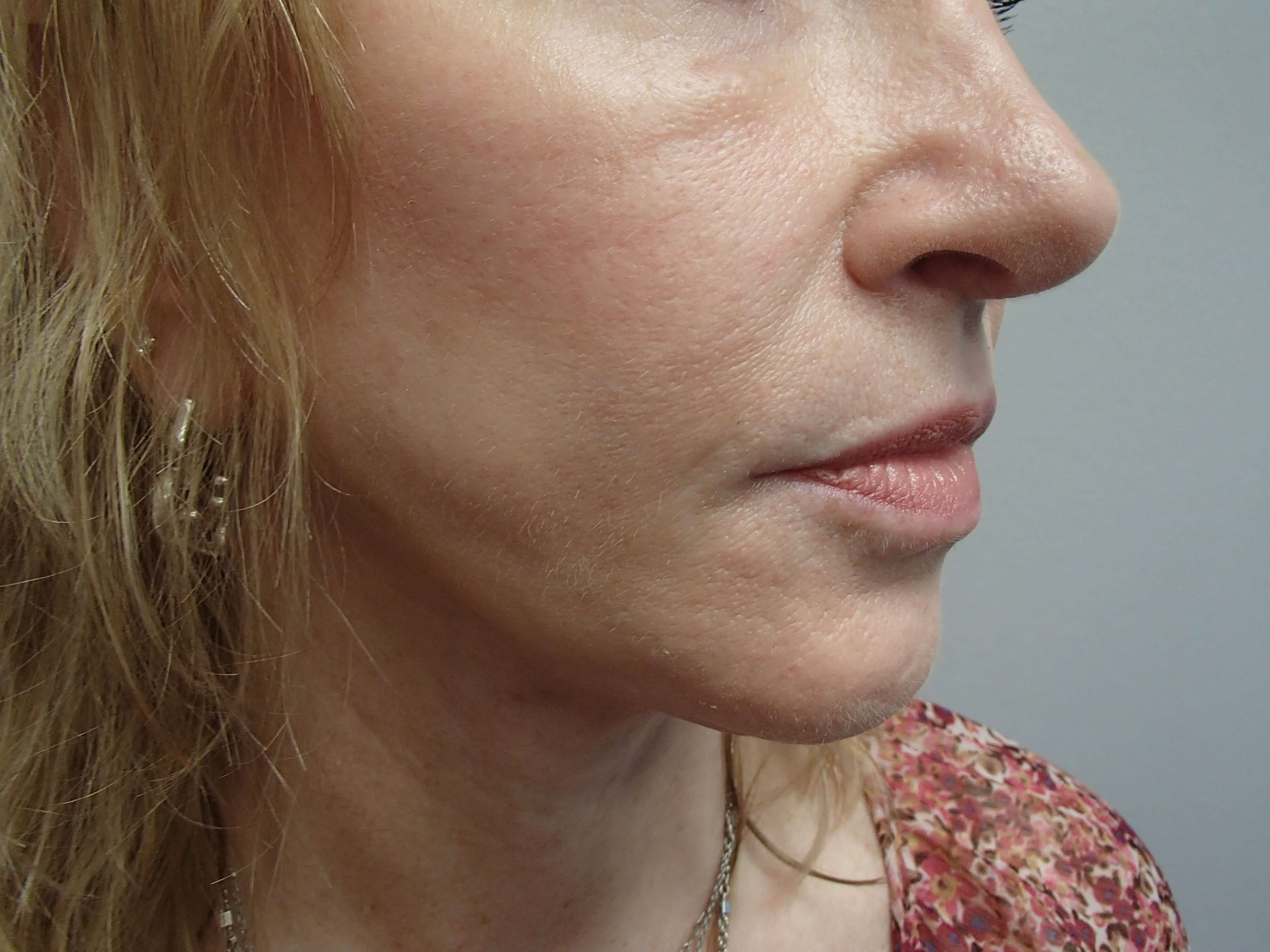 Neck Lift After