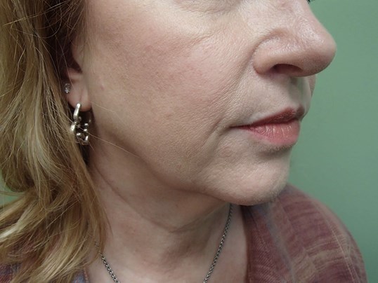 Neck Lift Before