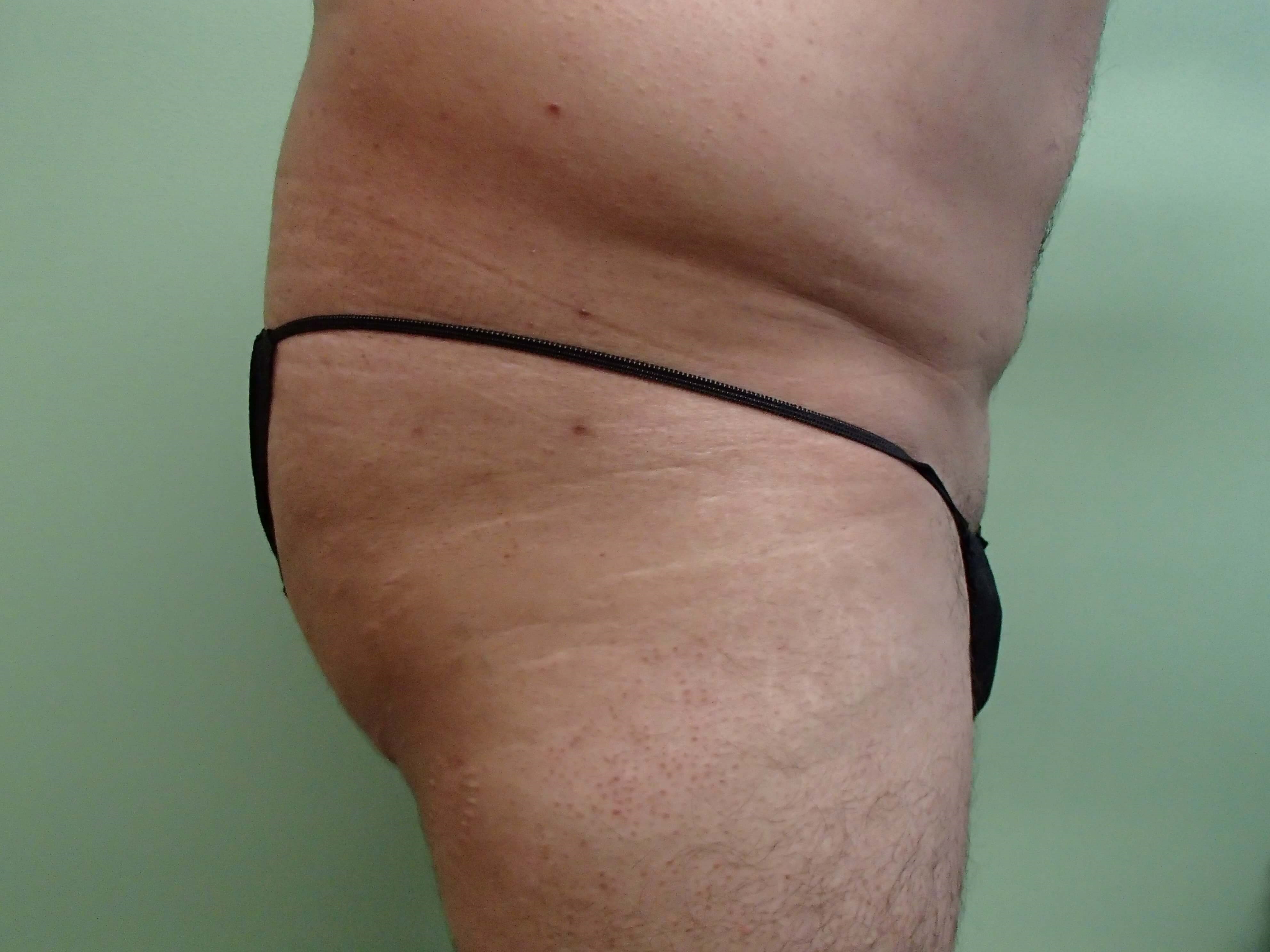 Male Brazilian Butt Lift Before