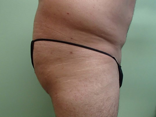Male Brazilian Butt Lift Before