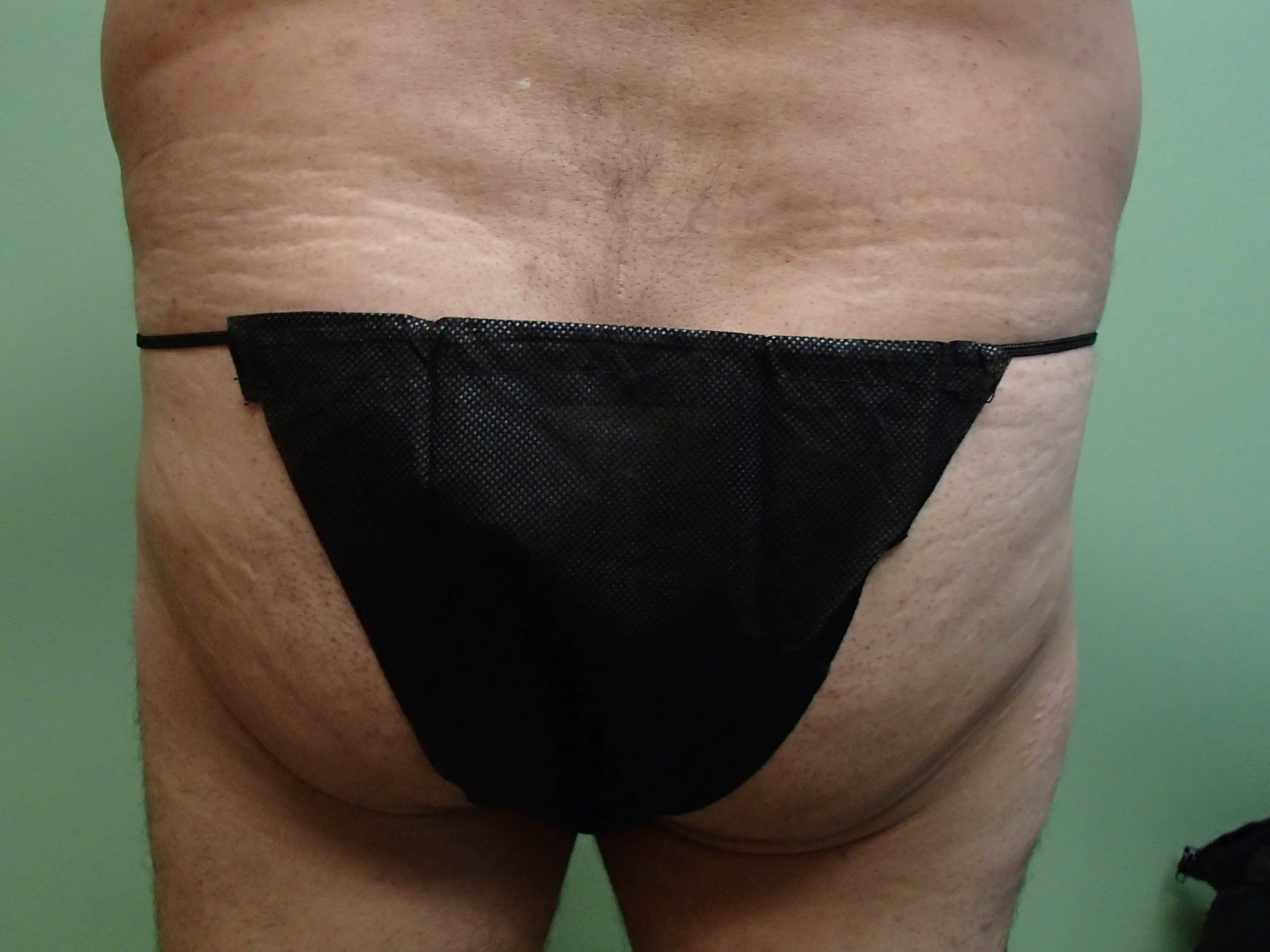 Male Brazilian Butt Lift Before