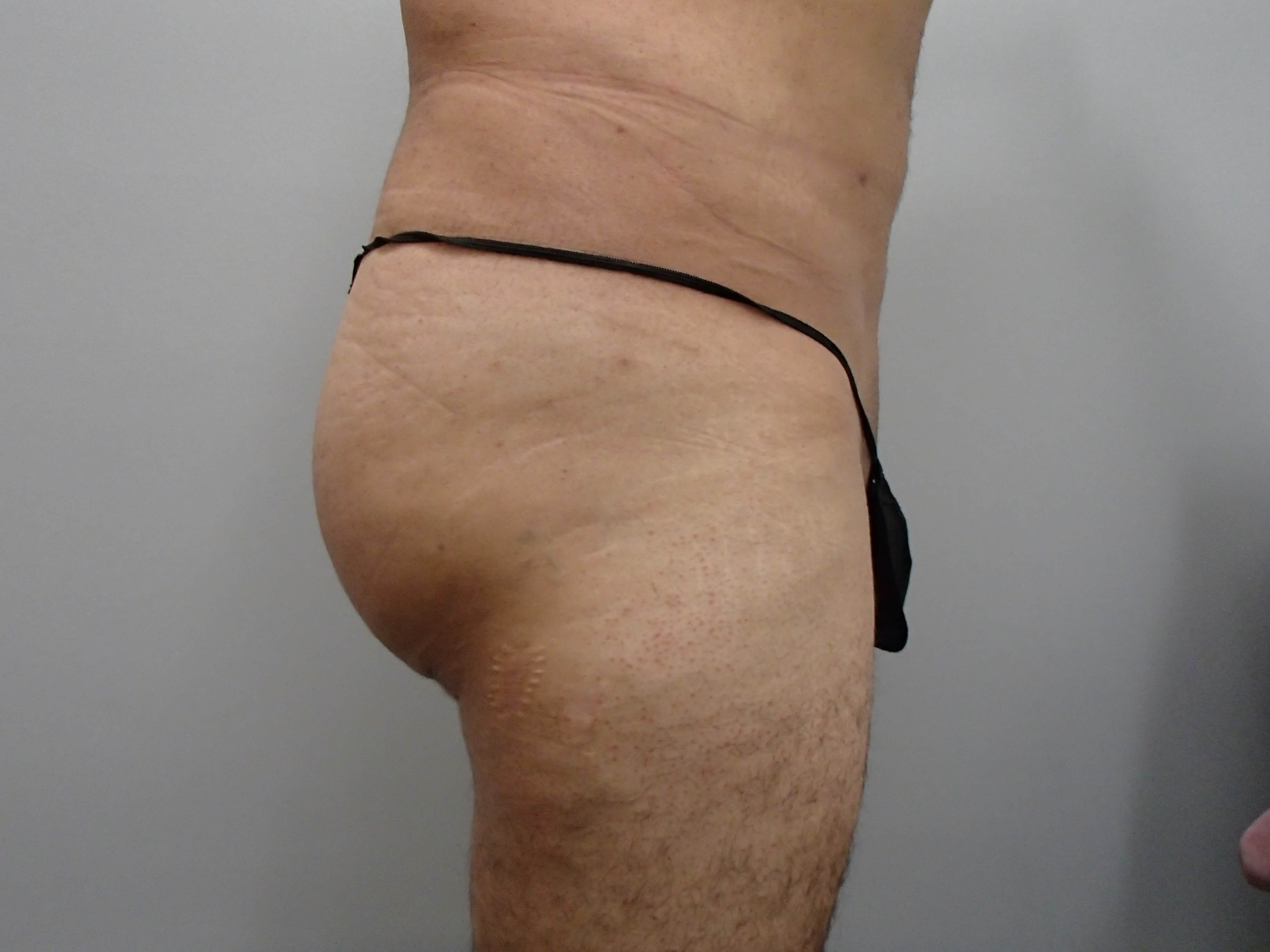 Male Brazilian Butt Lift After