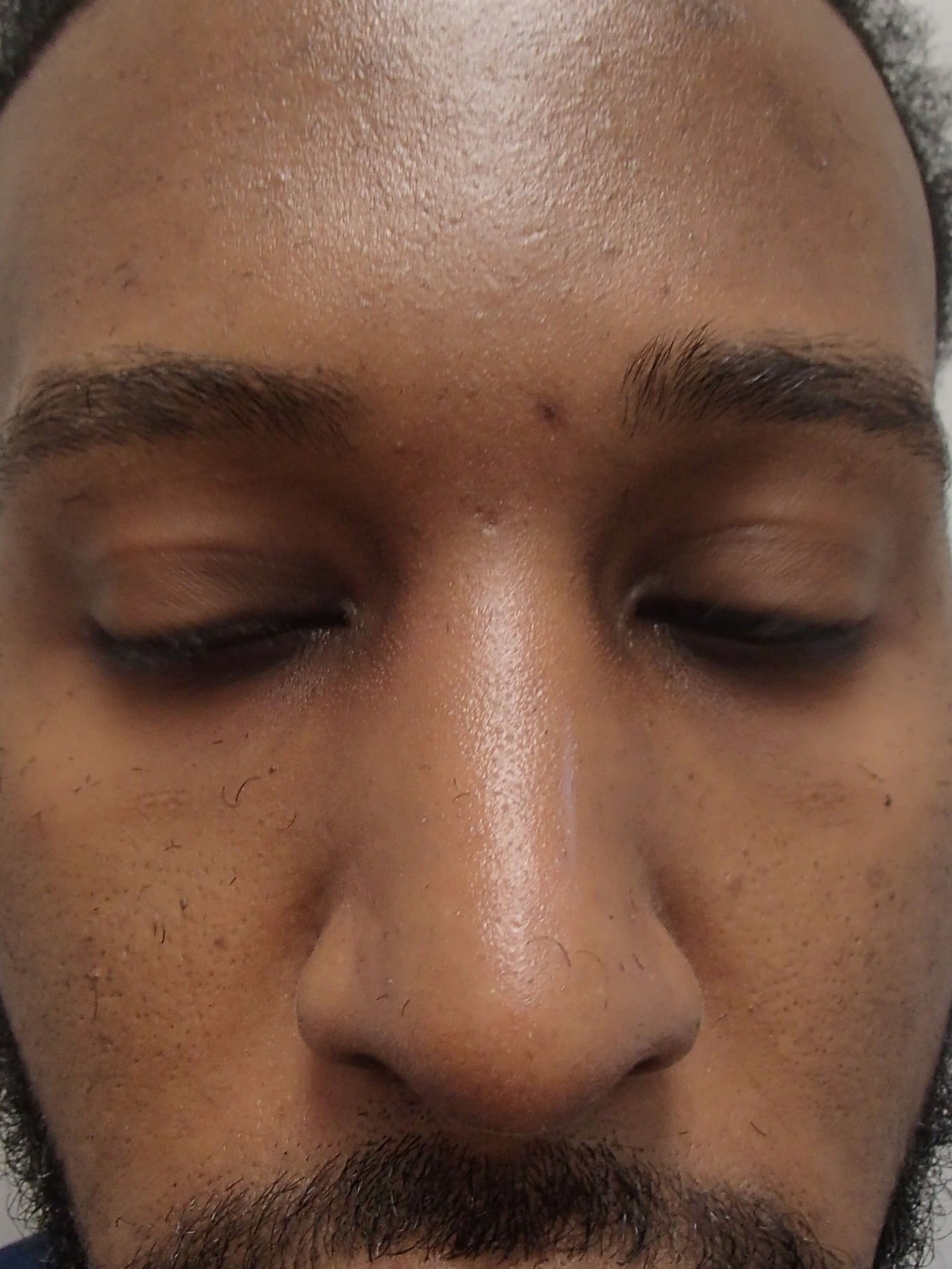 Rhinoplasty - Nose Job After