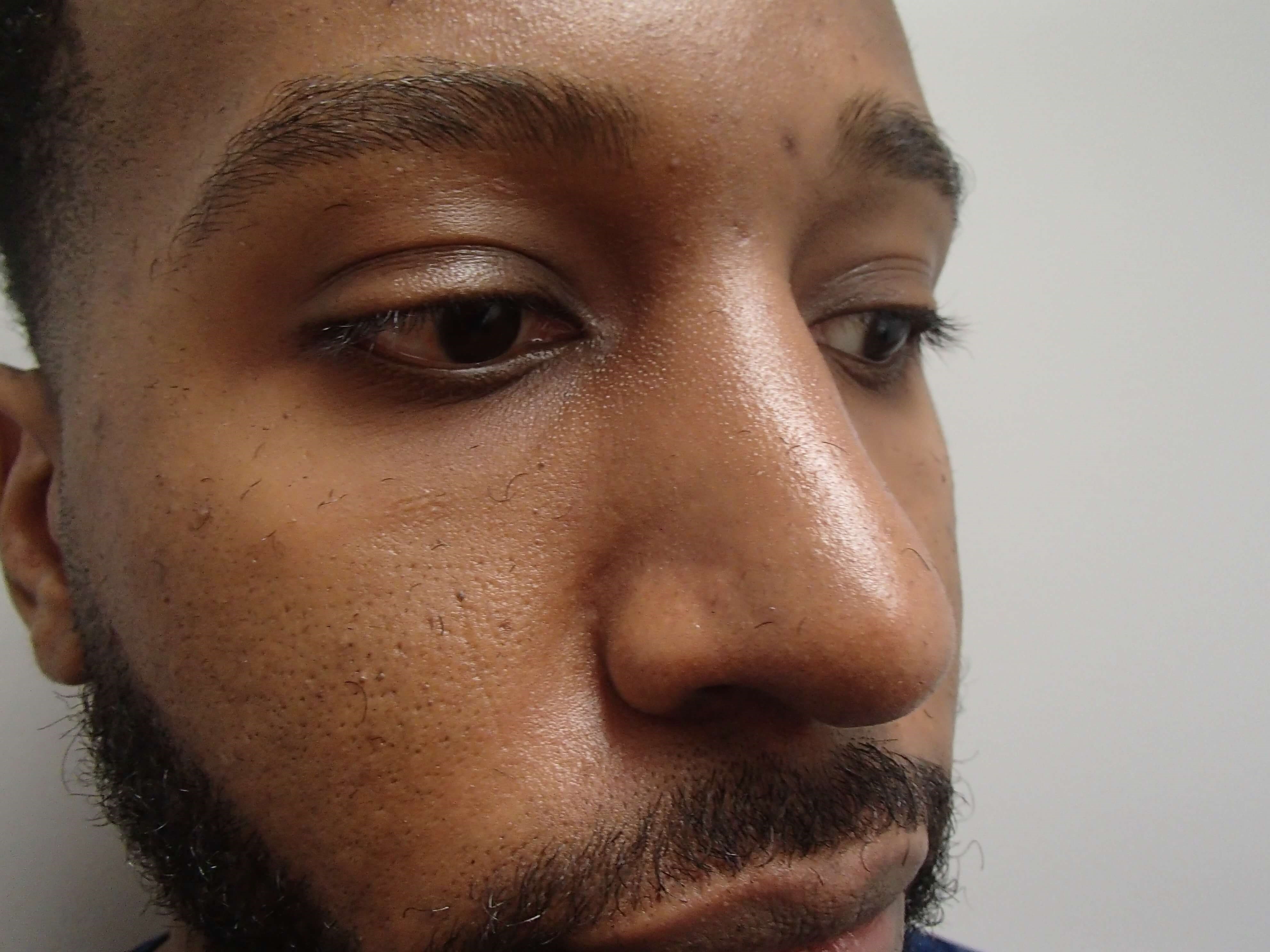Rhinoplasty - Nose Job After