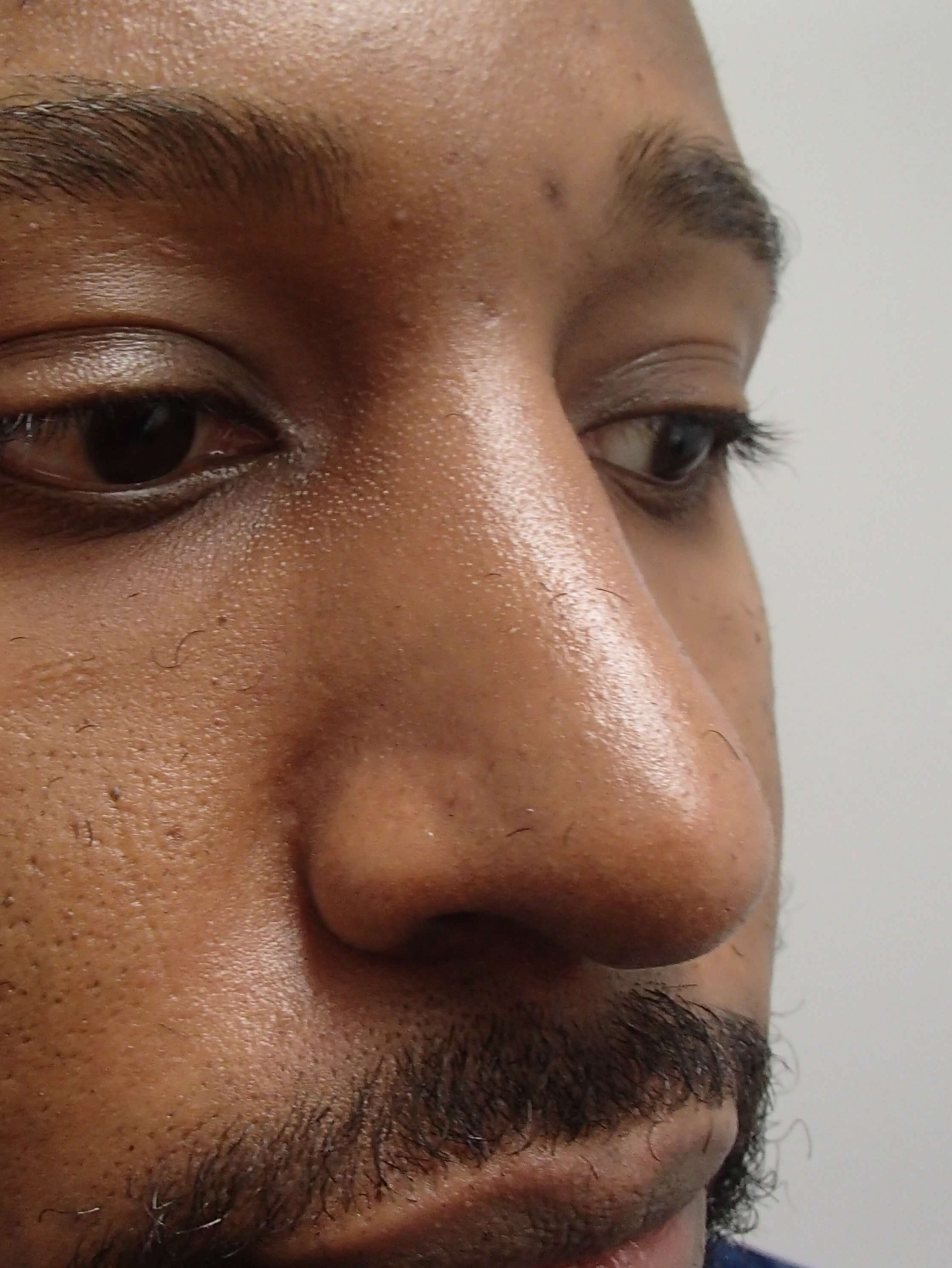 Rhinoplasty - Nose Job After