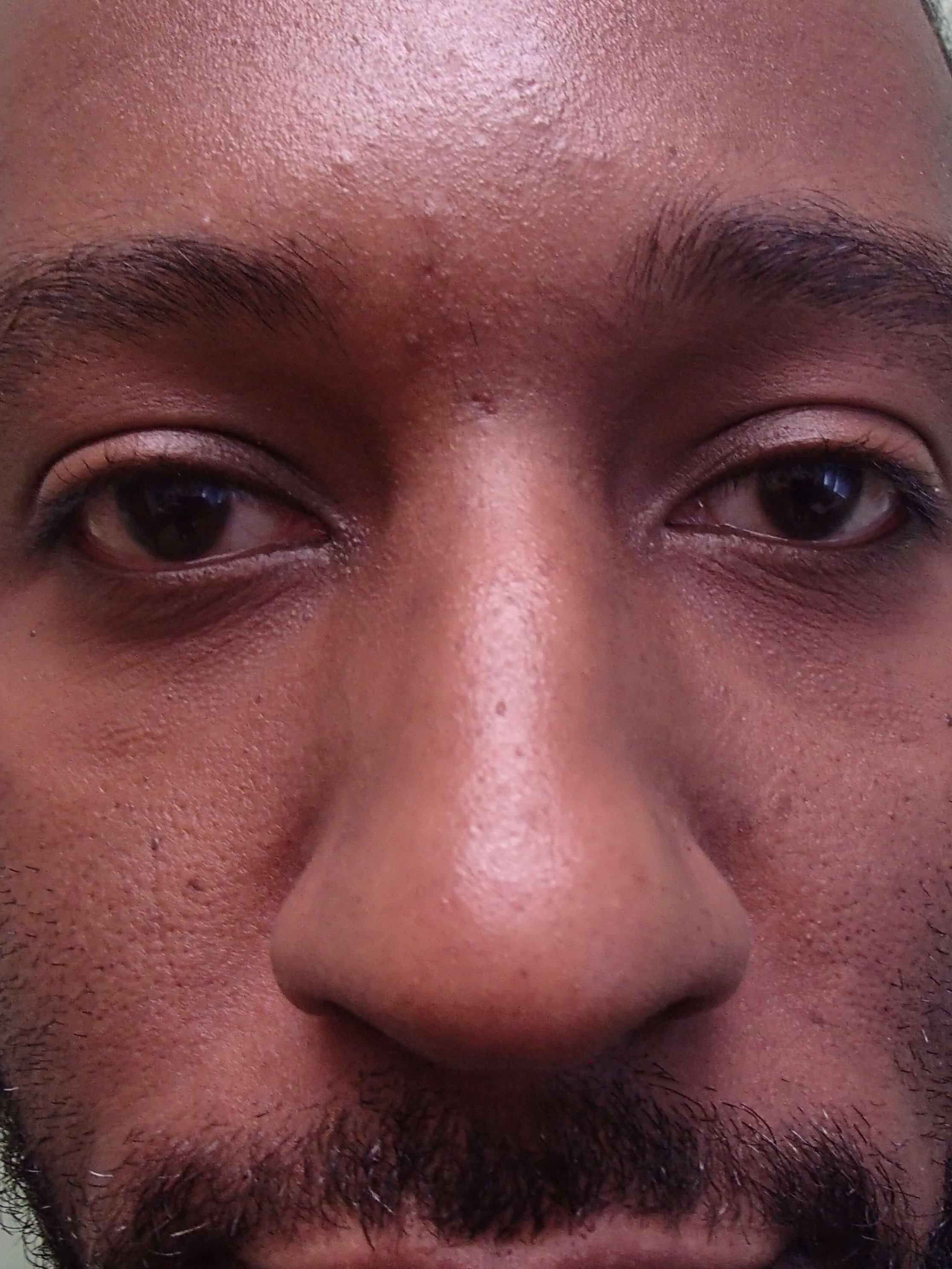 Rhinoplasty - Nose Job Before