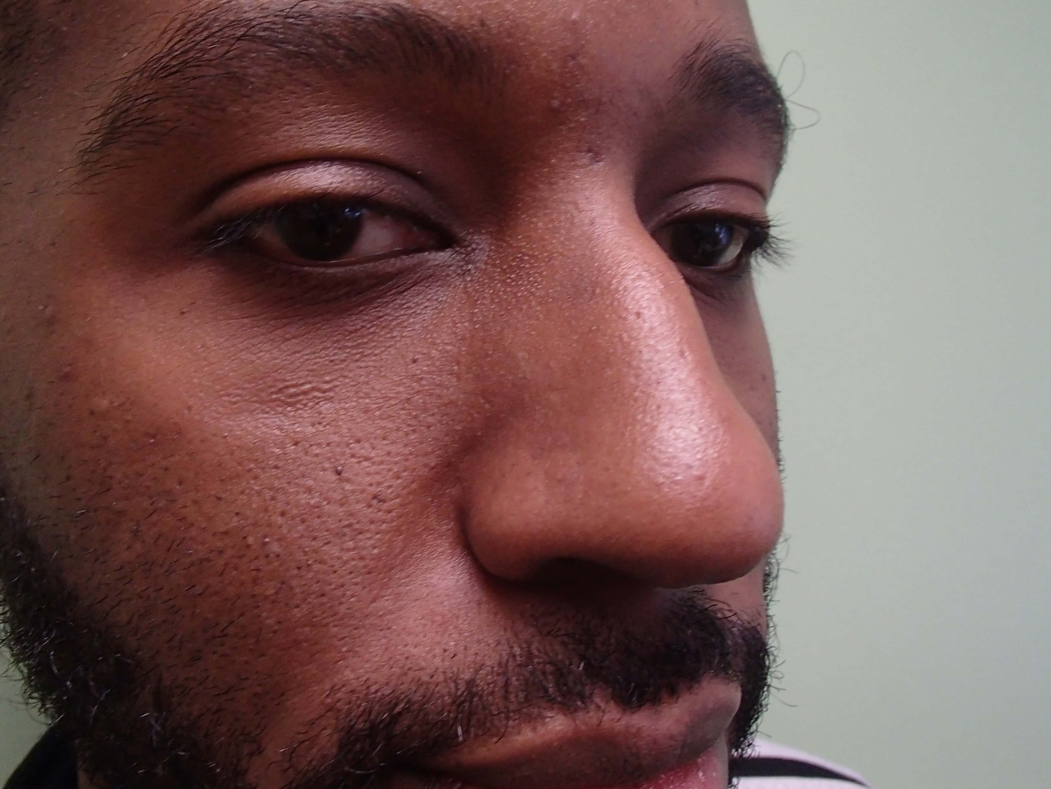 Rhinoplasty - Nose Job Before