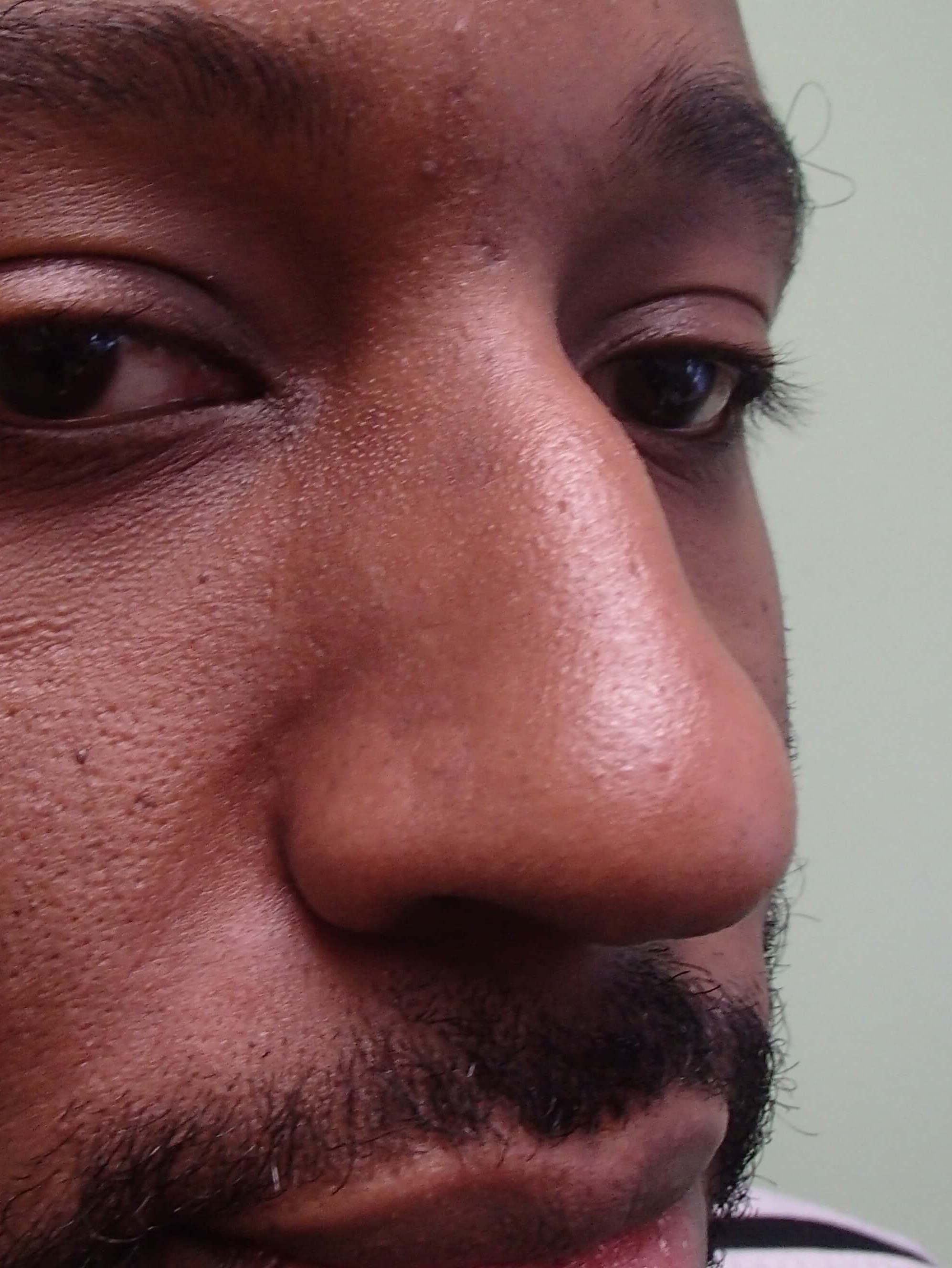 Rhinoplasty - Nose Job Before