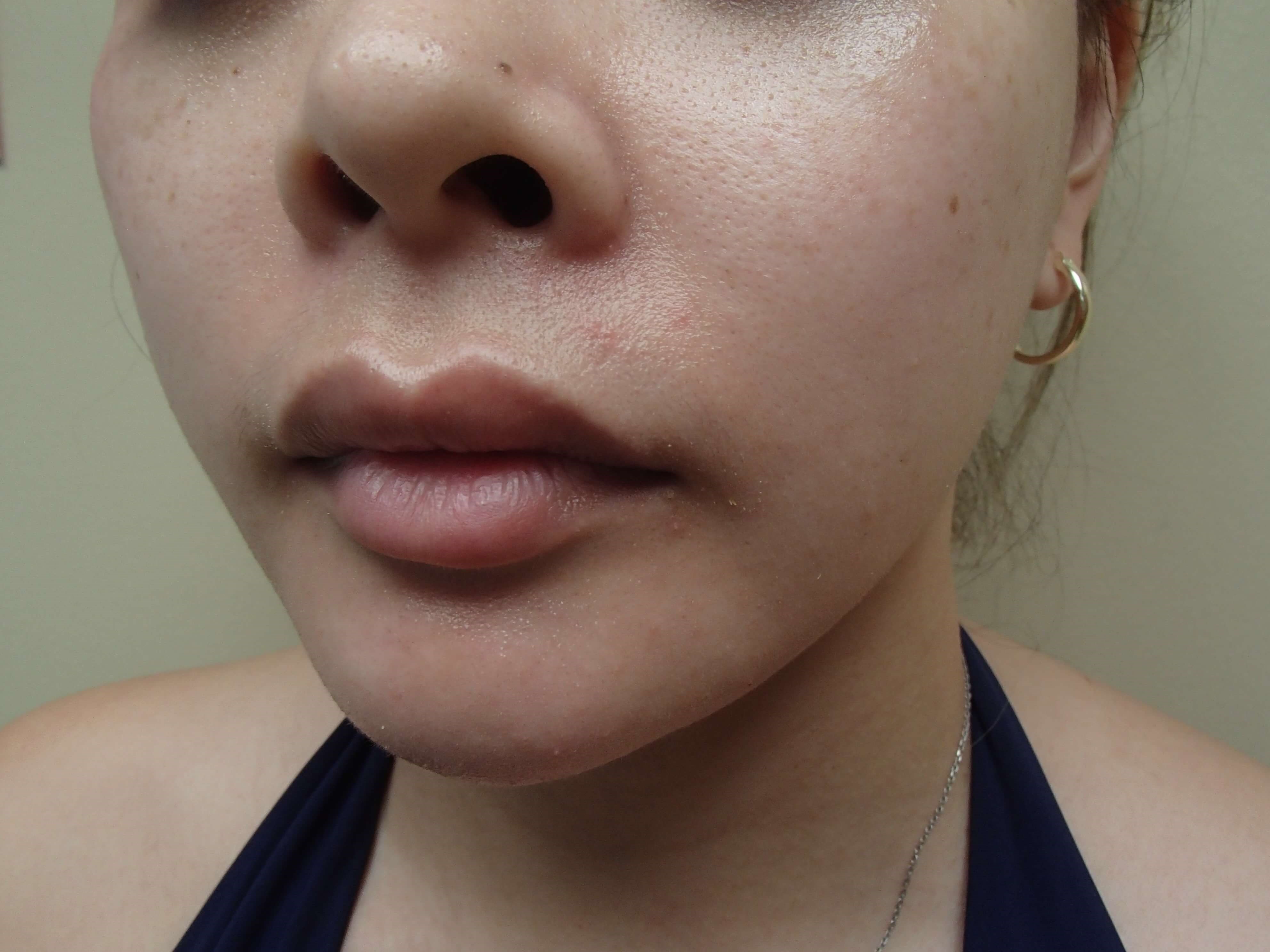 Facial Contouring After