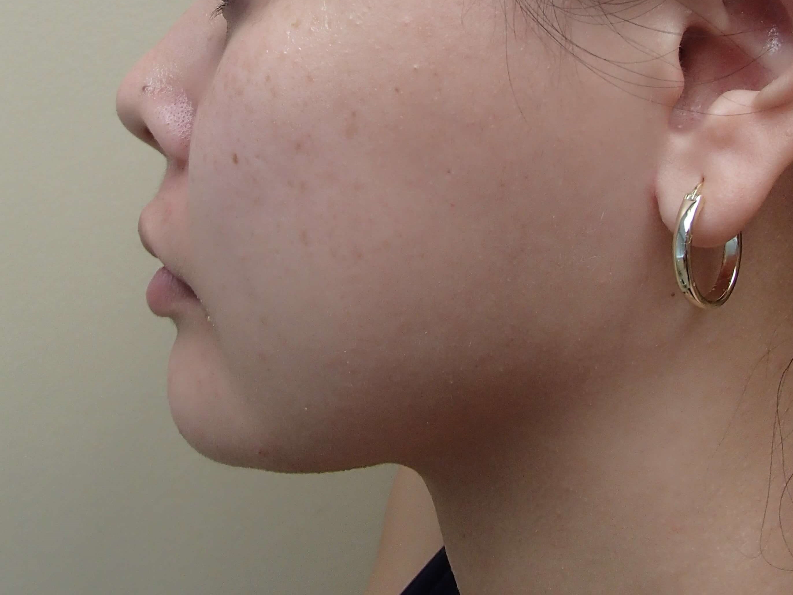 Facial Contouring After