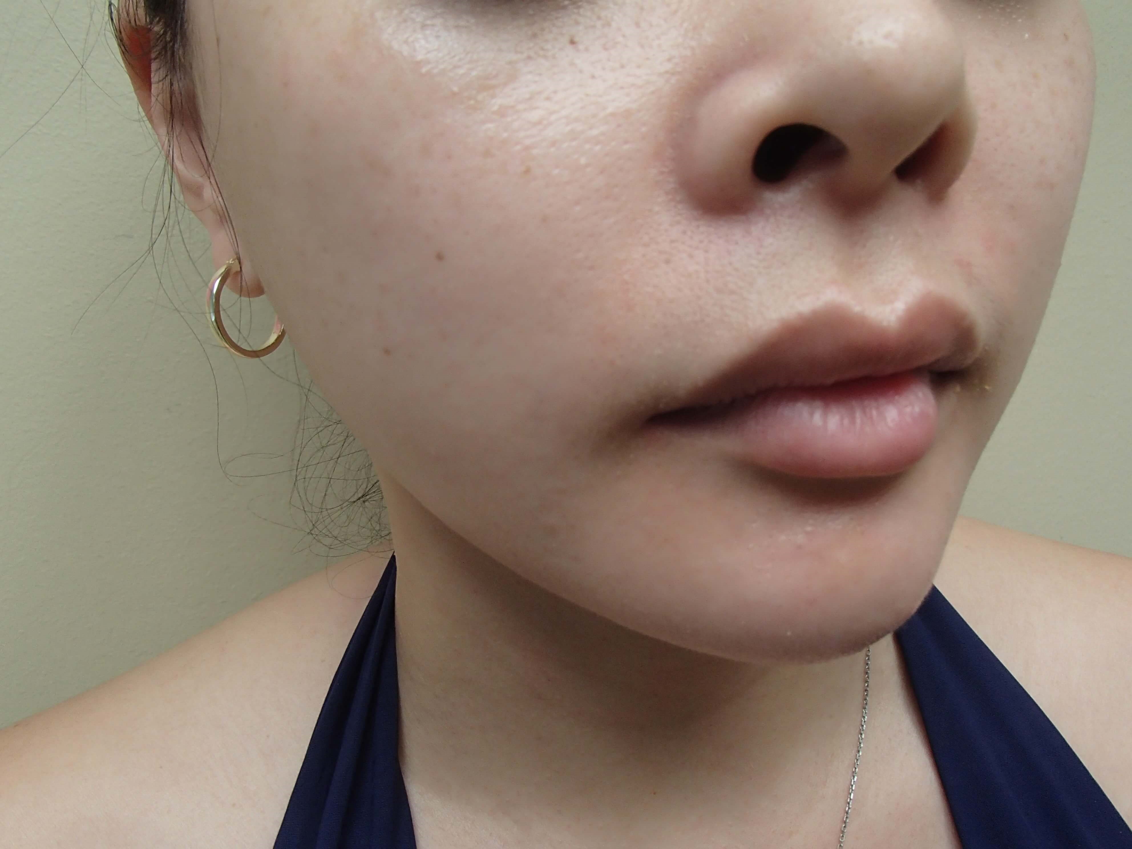 Facial Contouring After