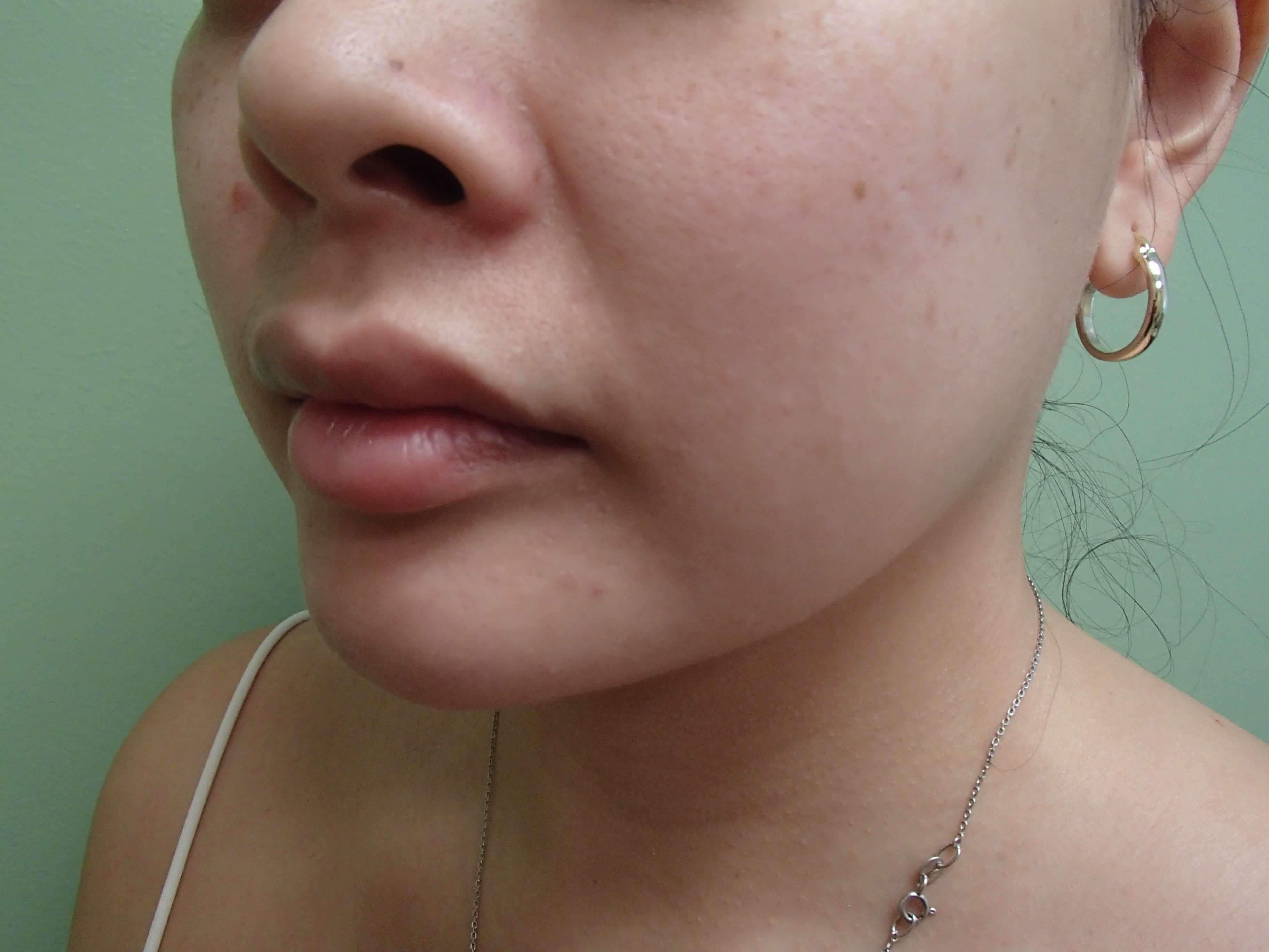 Facial Contouring Before