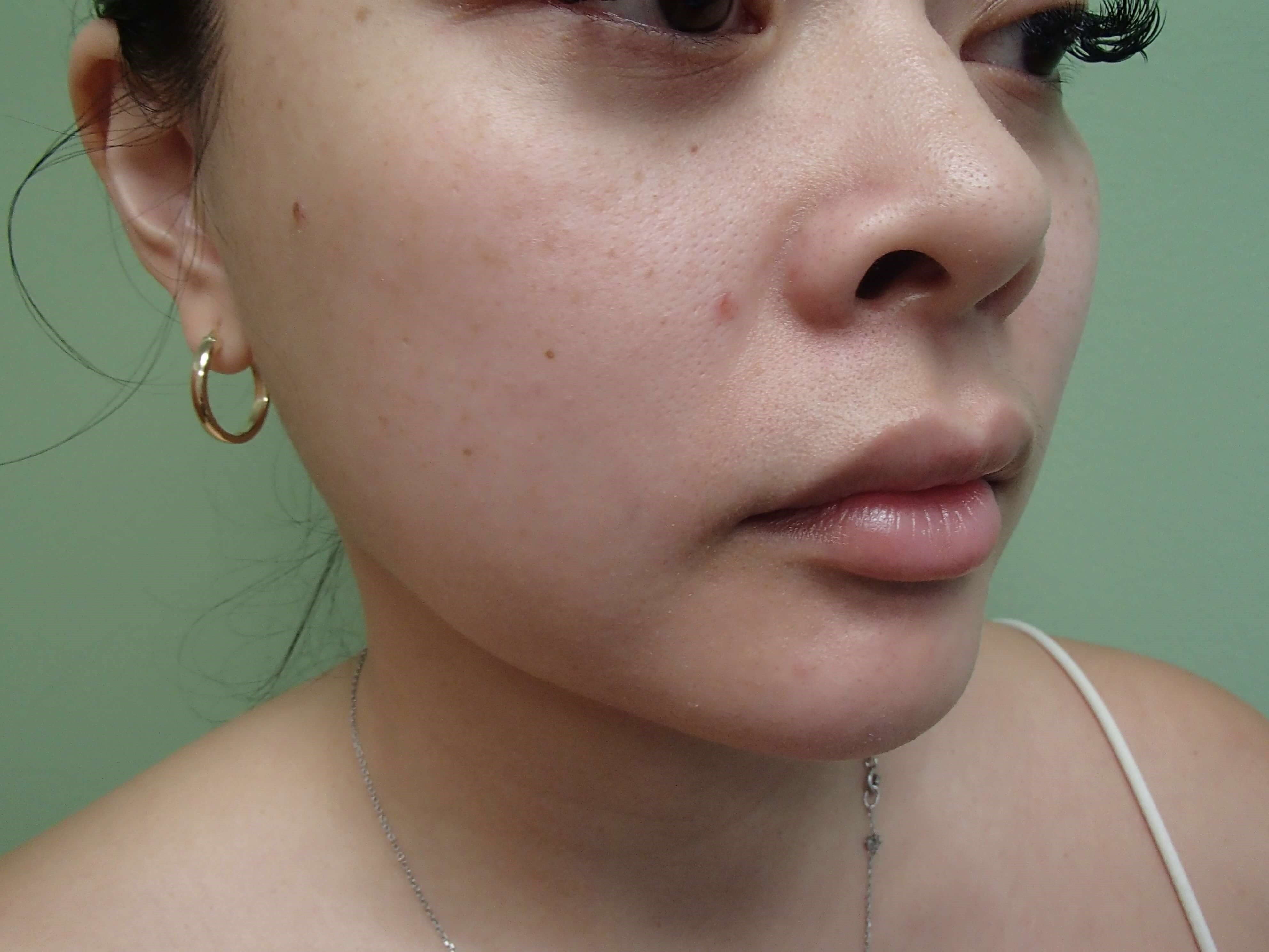 Facial Contouring Before