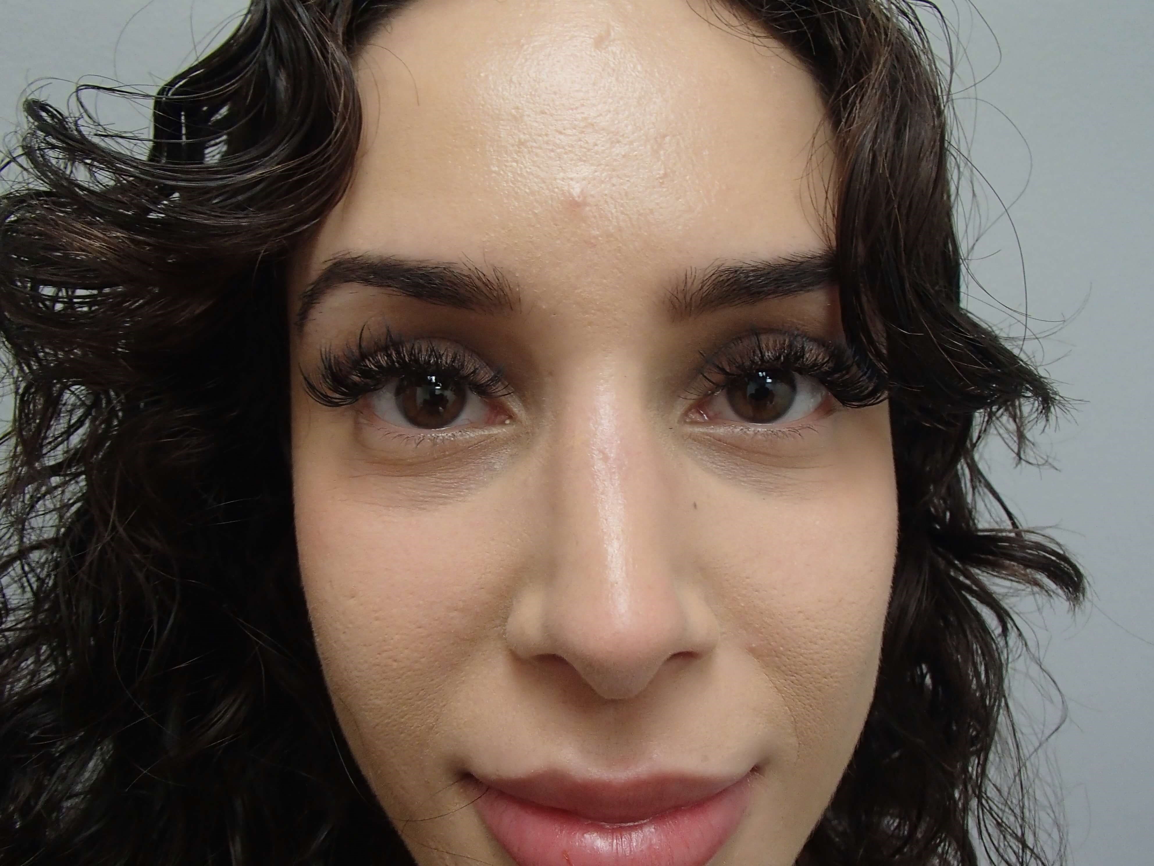 Rhinoplasty (Nose Job) After