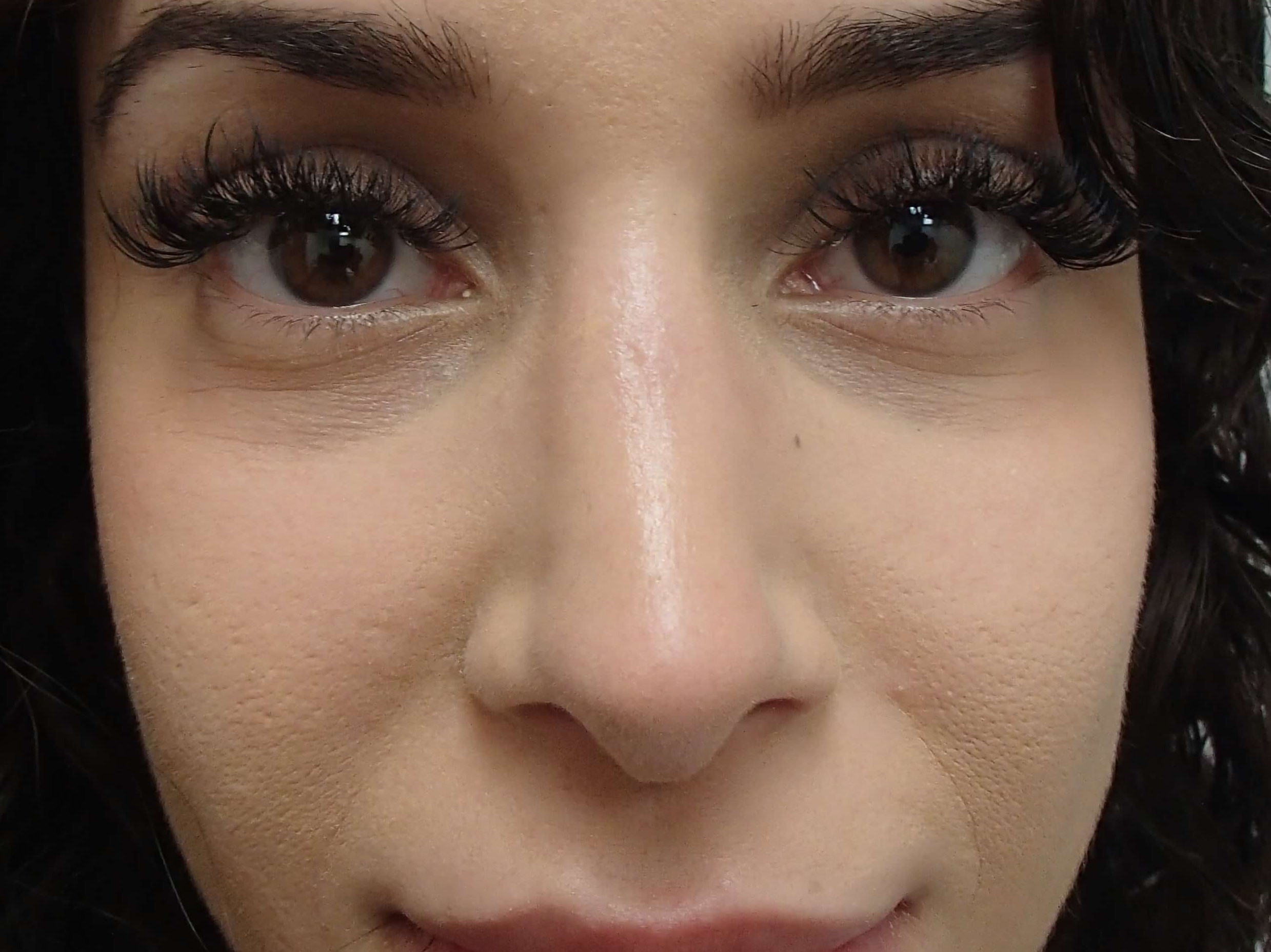 Rhinoplasty (Nose Job) After