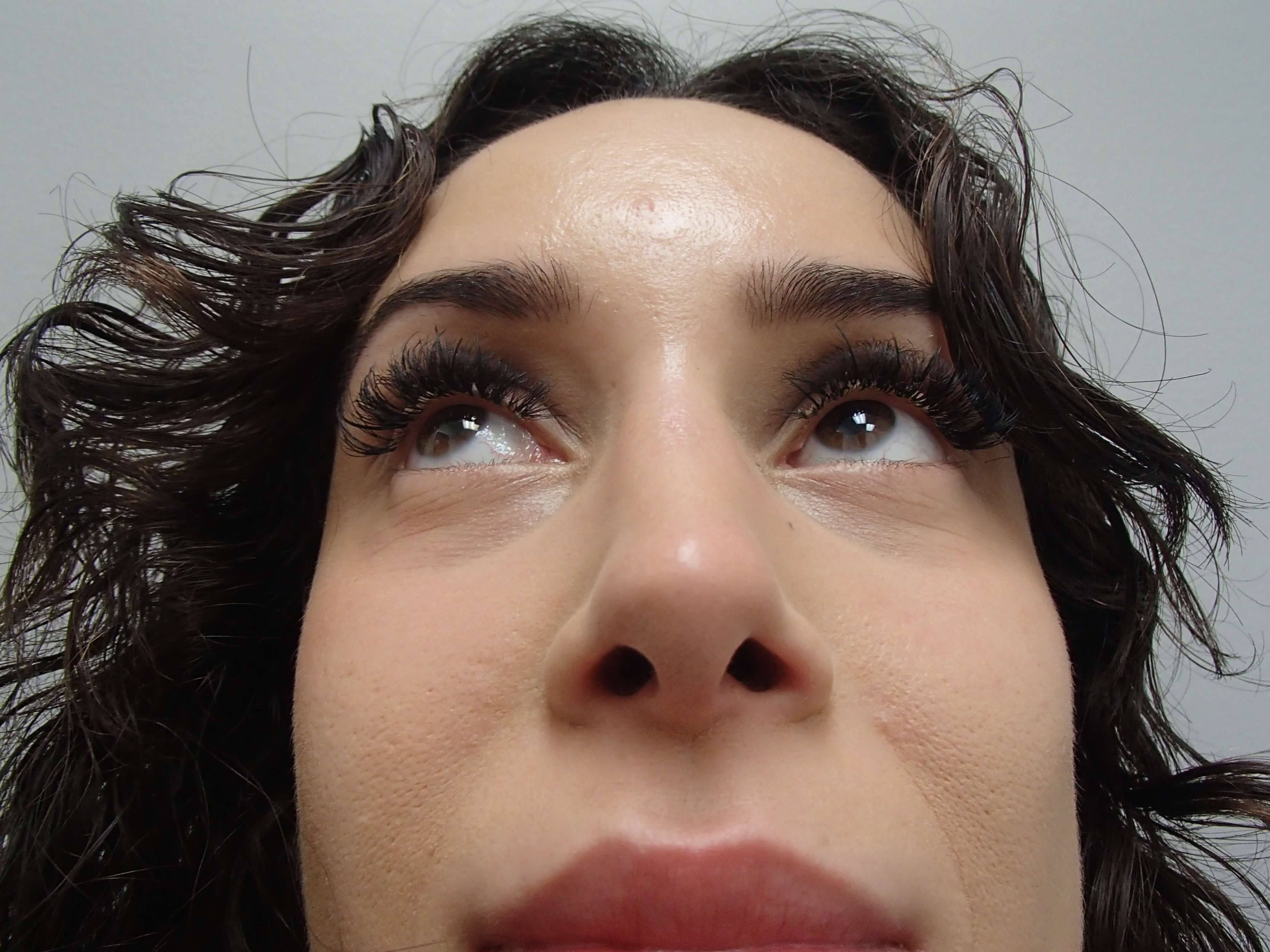 Rhinoplasty (Nose Job) After