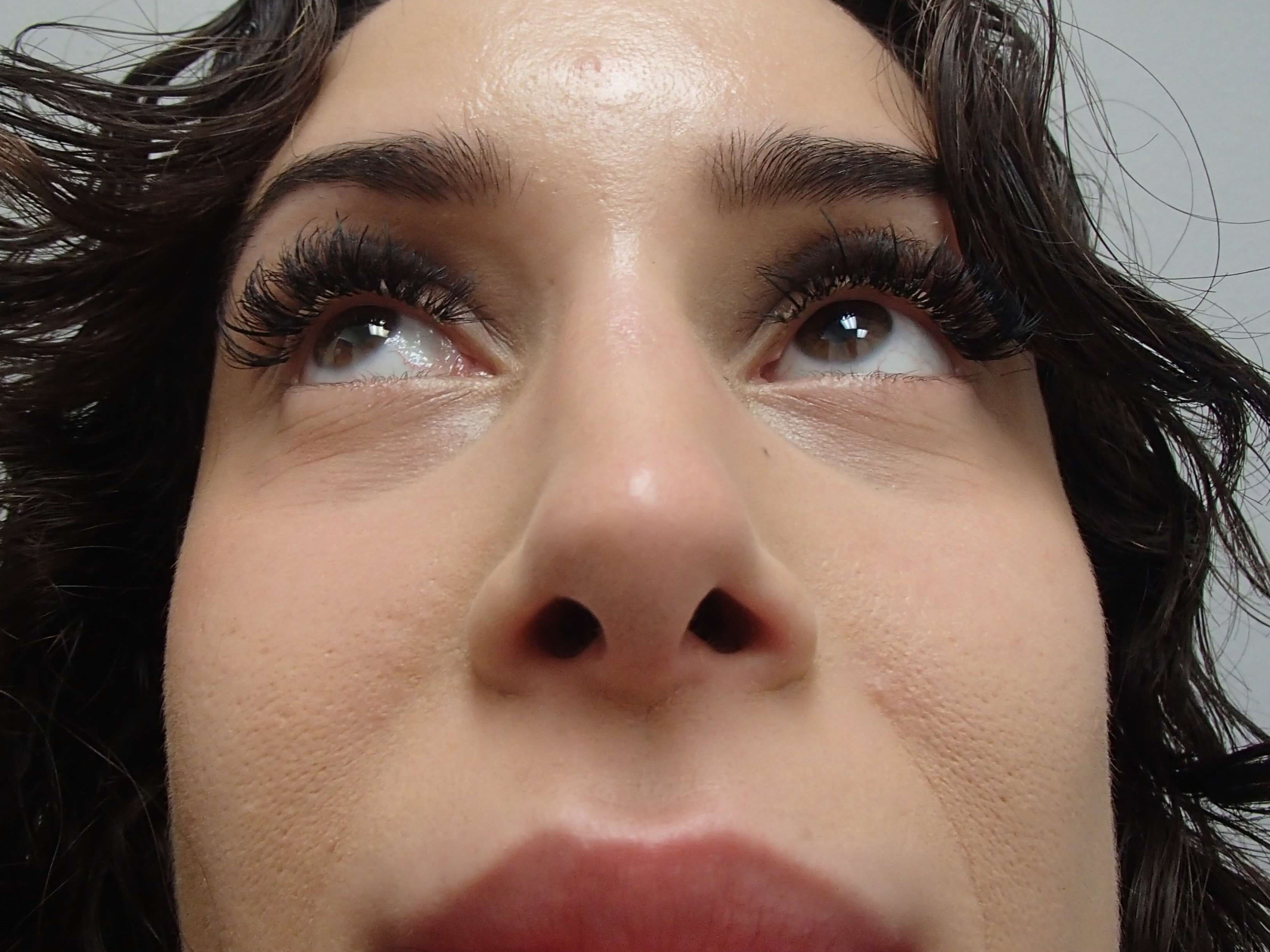 Rhinoplasty (Nose Job) After