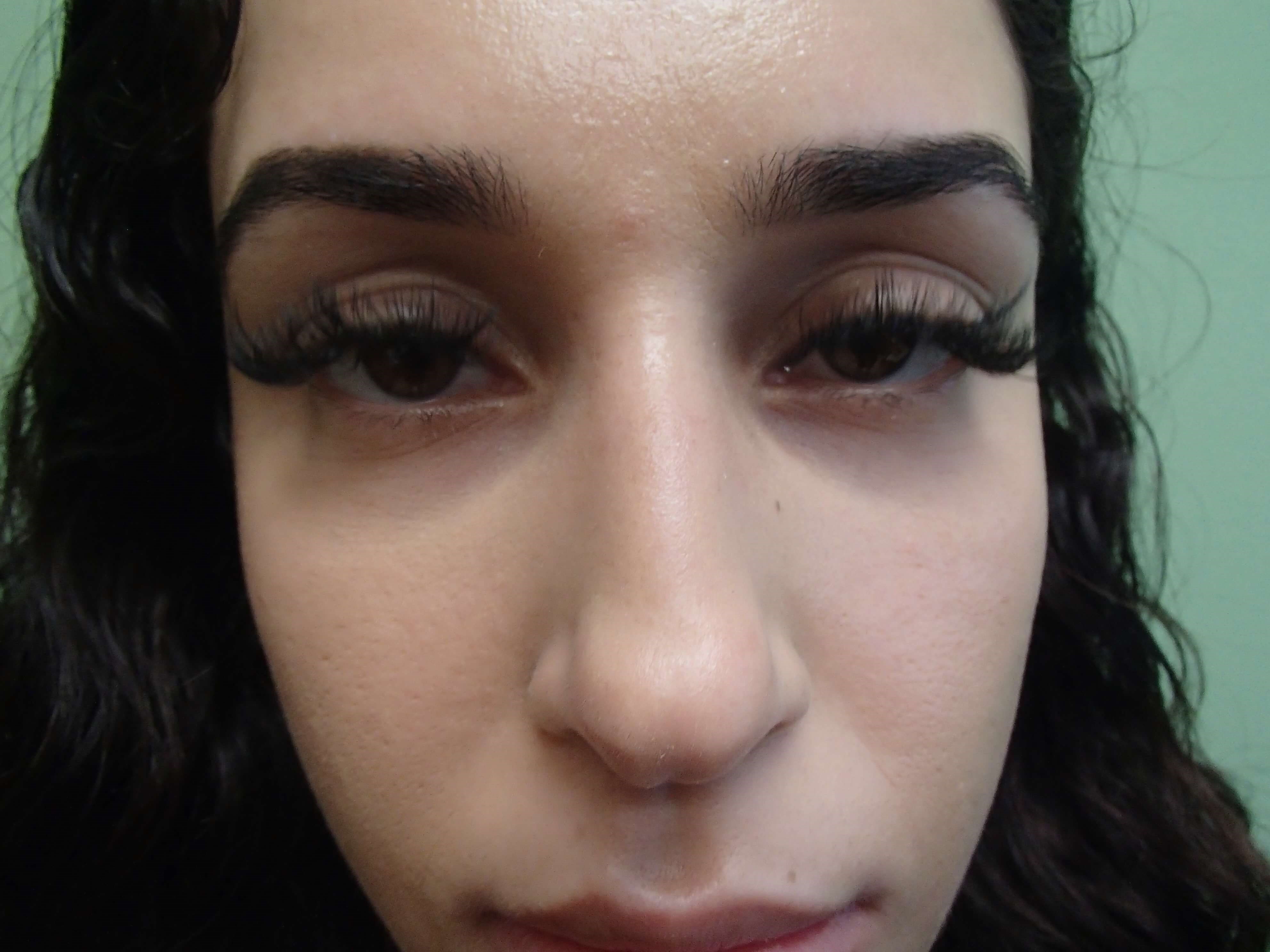 Rhinoplasty (Nose Job) Before