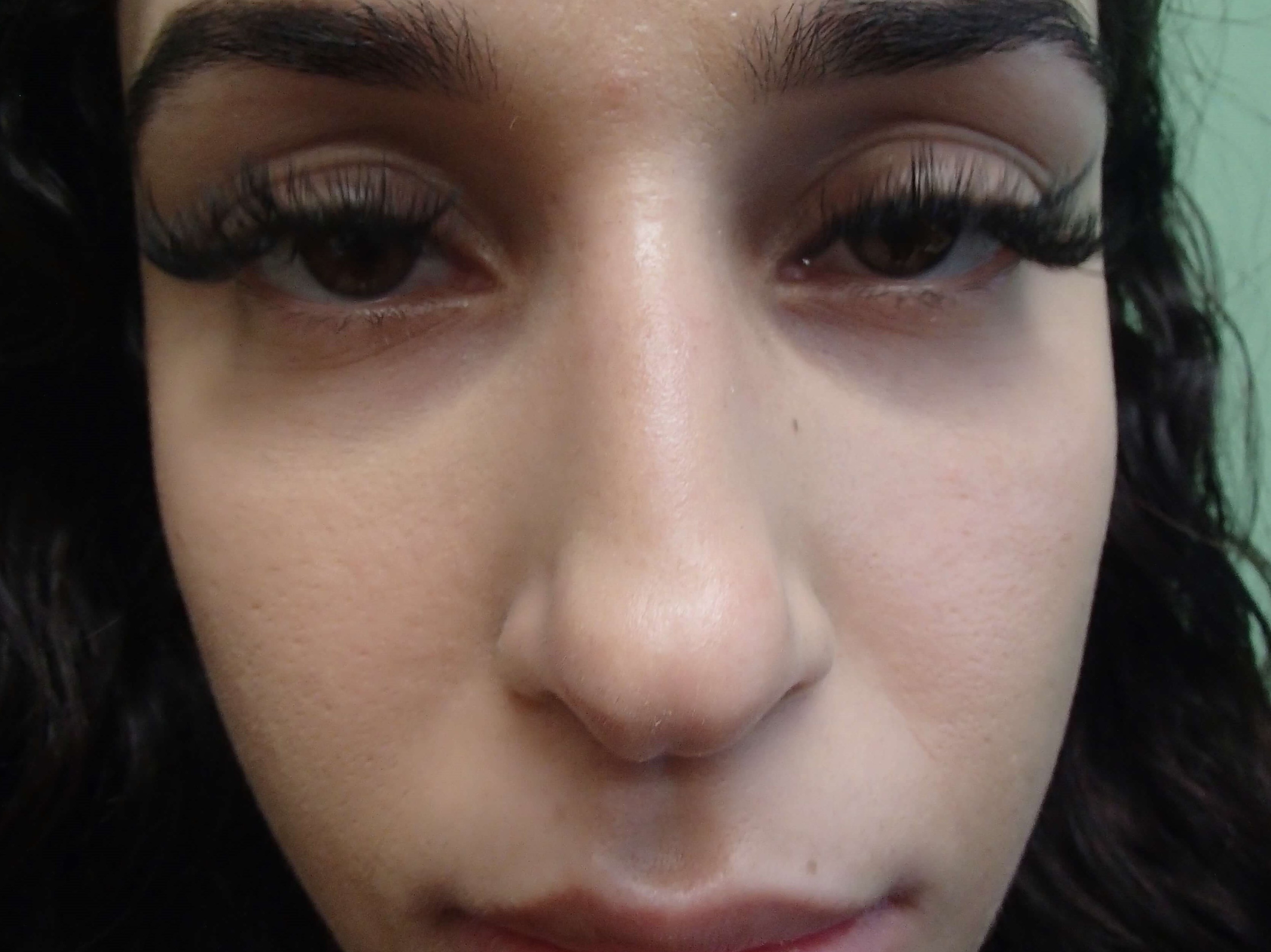 Rhinoplasty (Nose Job) Before