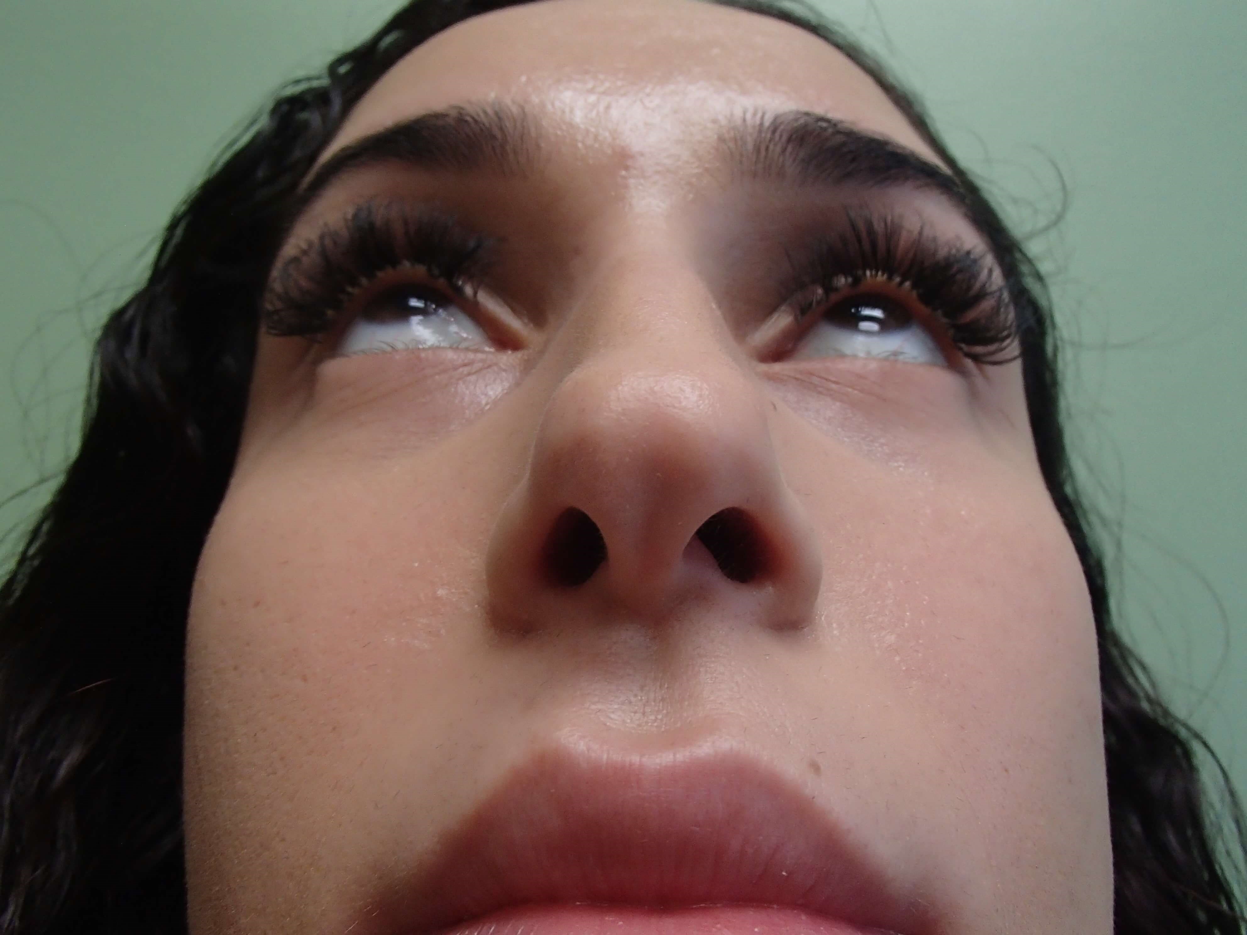 Rhinoplasty (Nose Job) Before
