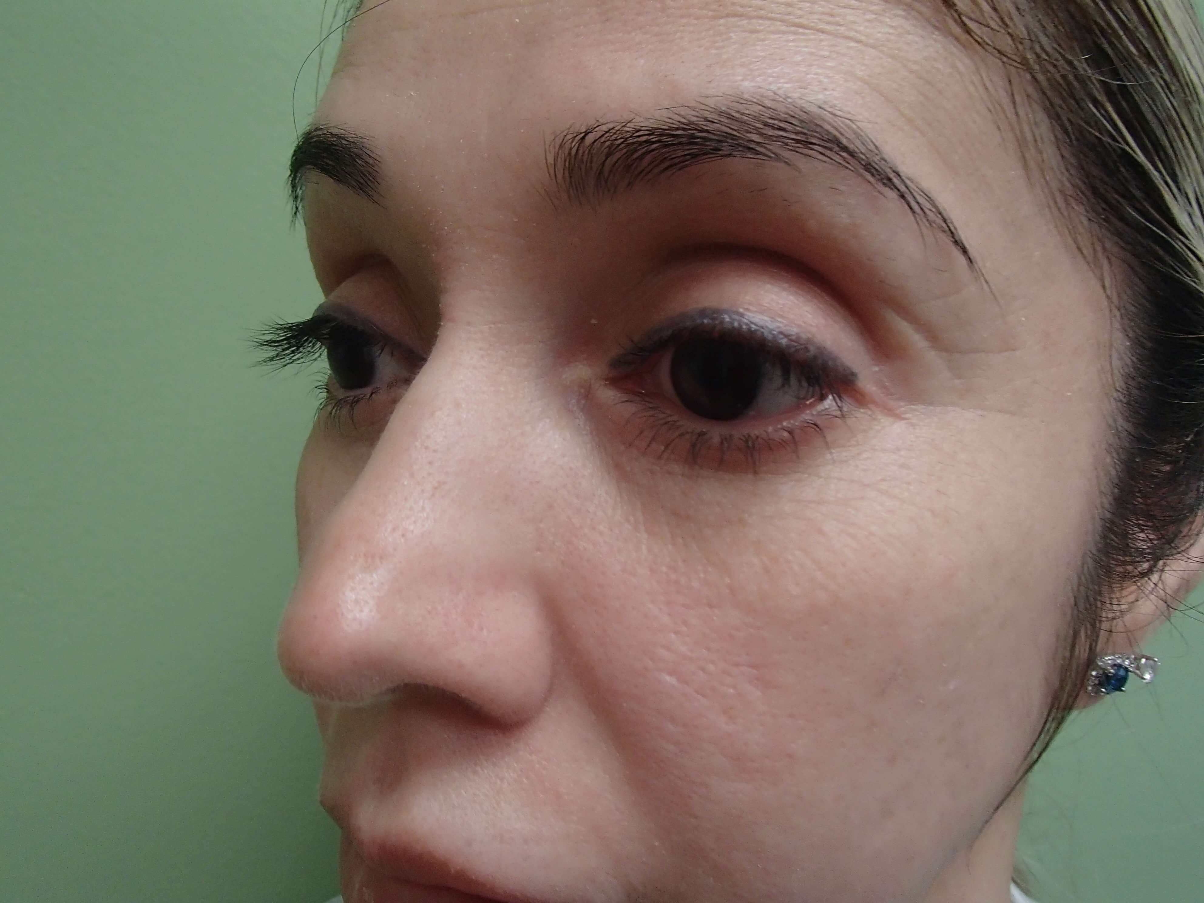Rhinoplasty (Nose Job) Before