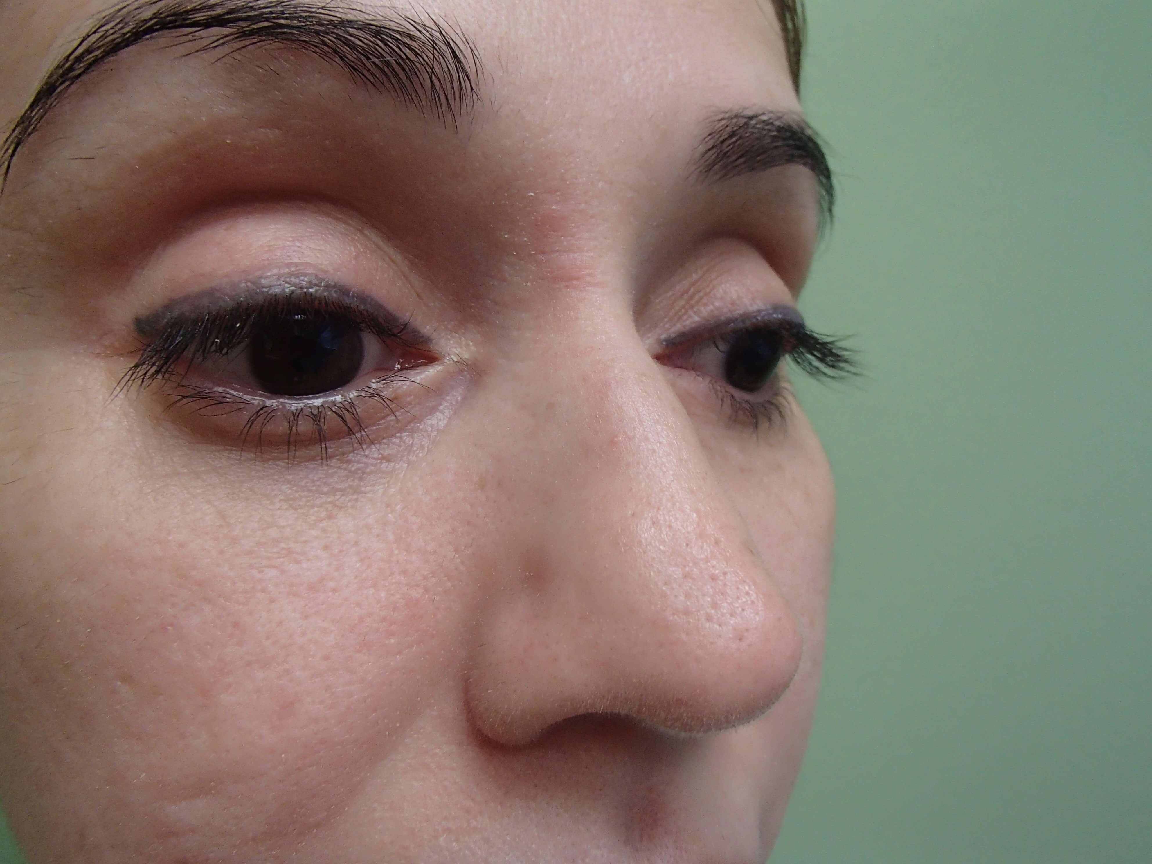 Rhinoplasty (Nose Job) Before