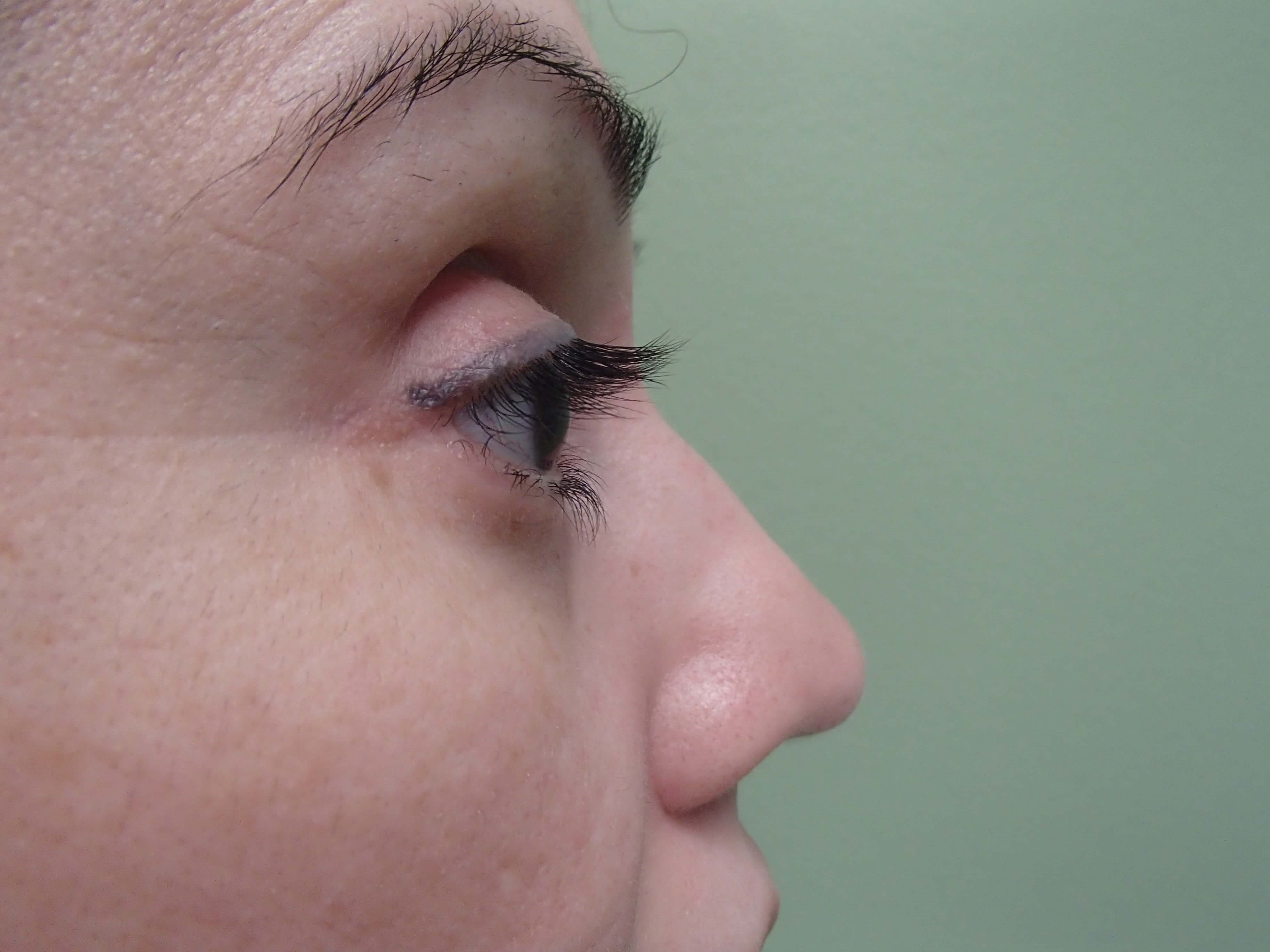 Rhinoplasty (Nose Job) Before