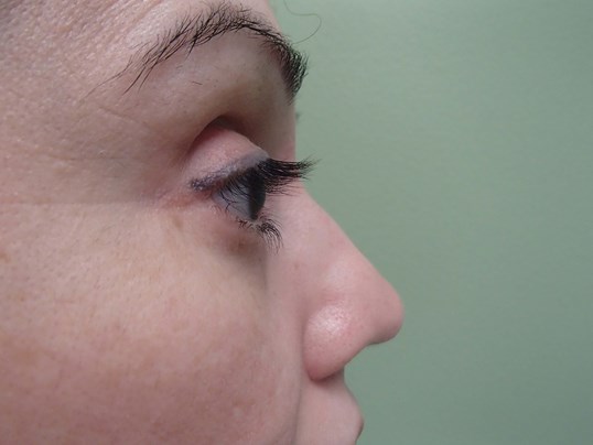 Rhinoplasty (Nose Job) Before