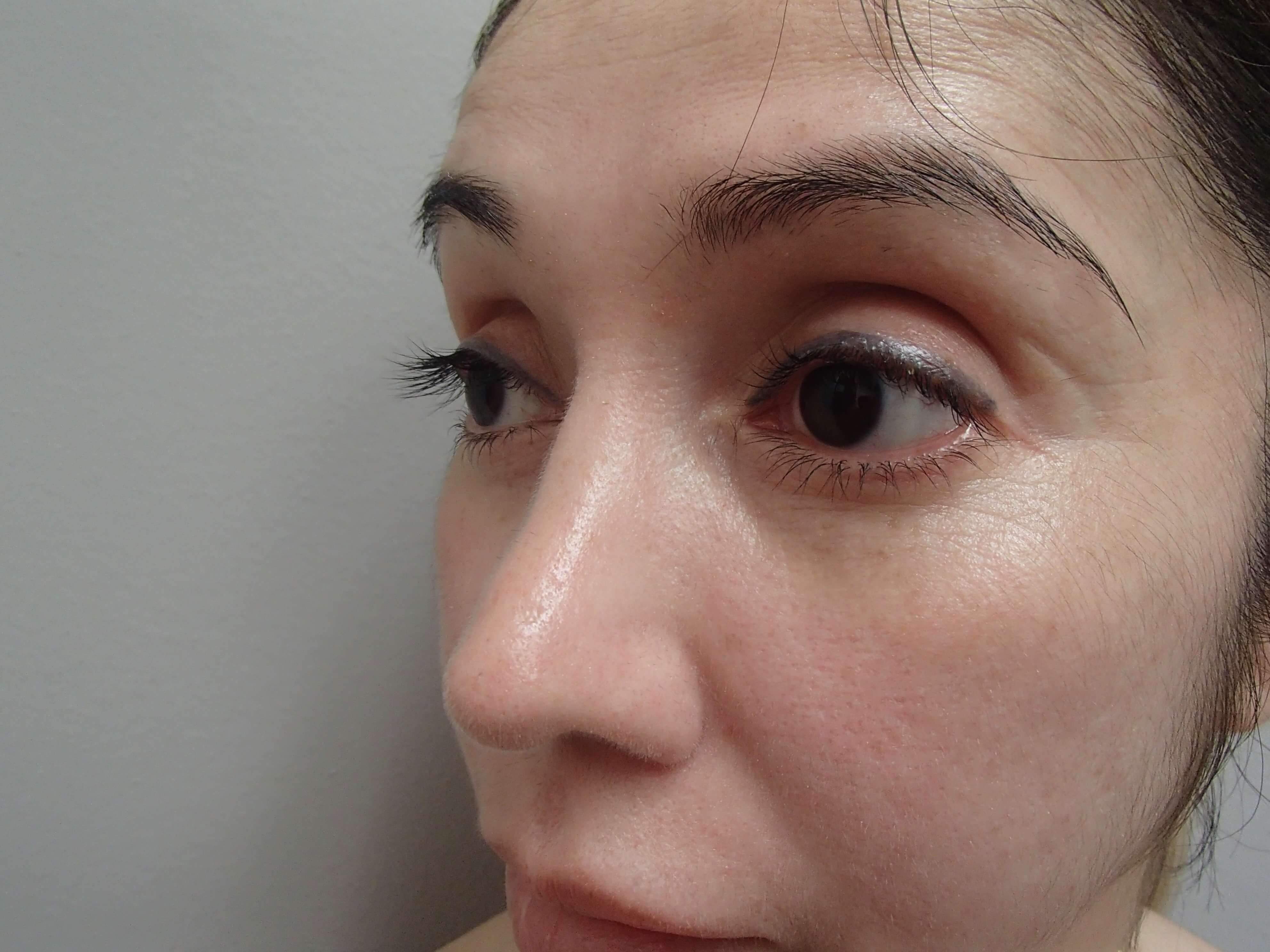 Rhinoplasty (Nose Job) After
