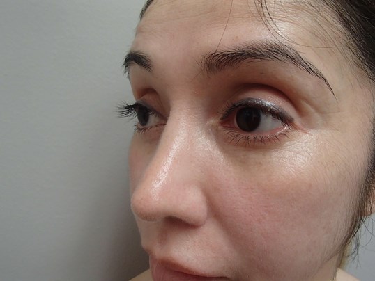 Rhinoplasty (Nose Job) After