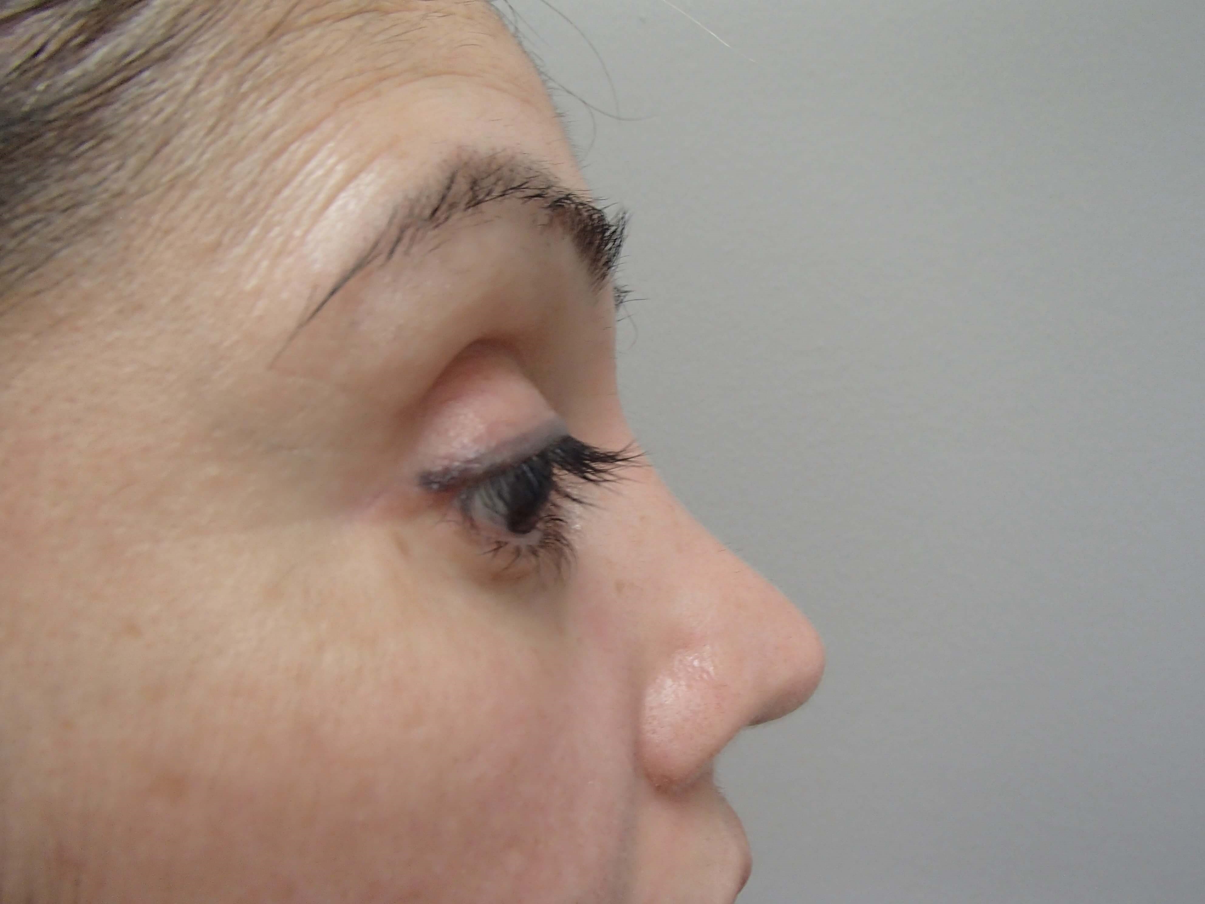 Rhinoplasty (Nose Job) After