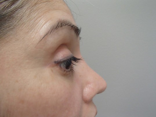 Rhinoplasty (Nose Job) After