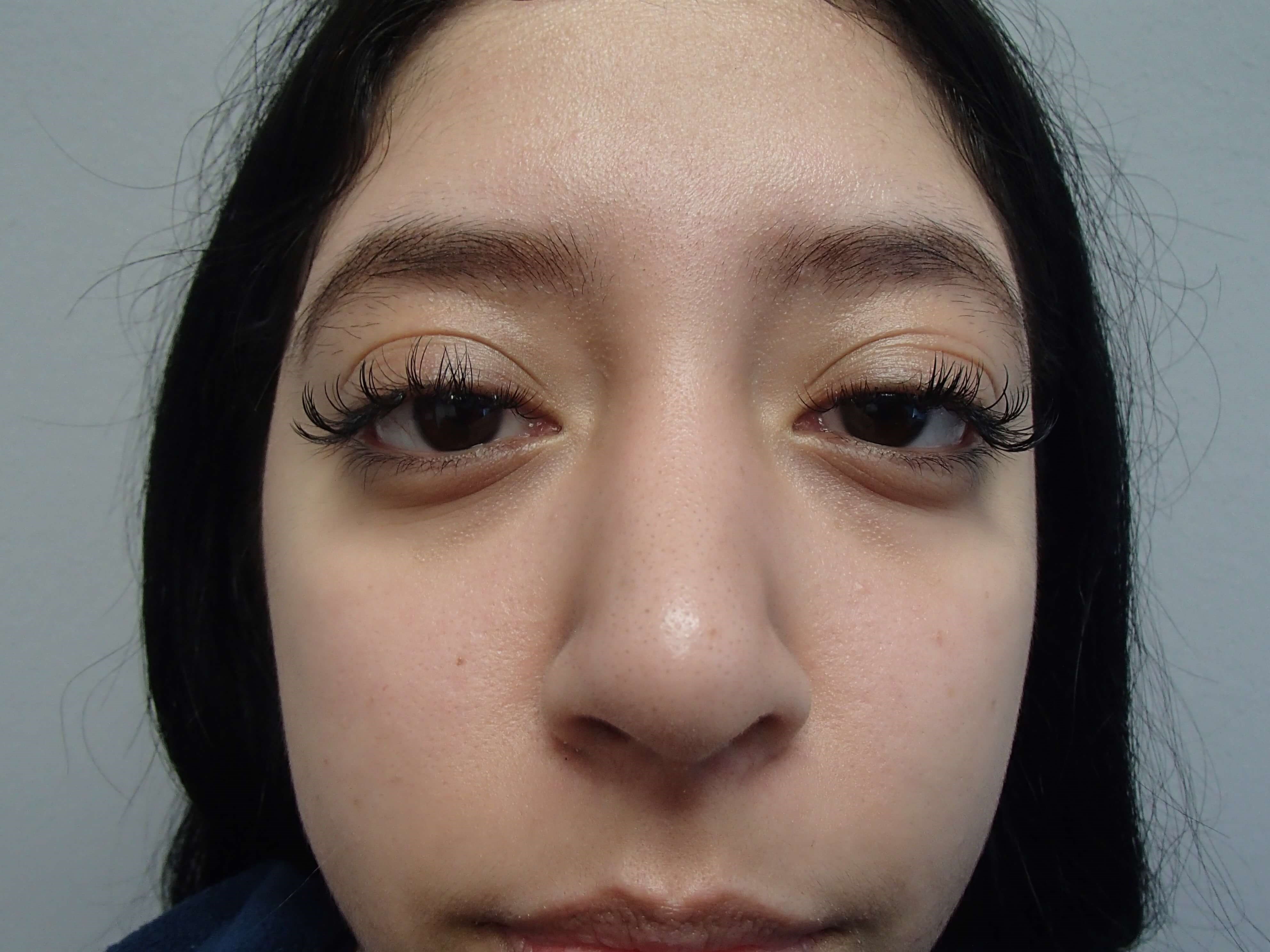 Rhinoplasty (Nose Job) After