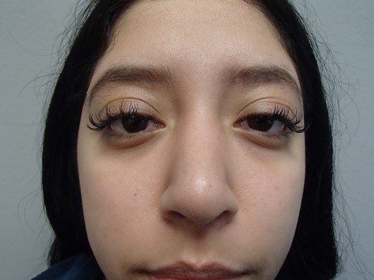 Rhinoplasty (Nose Job) After