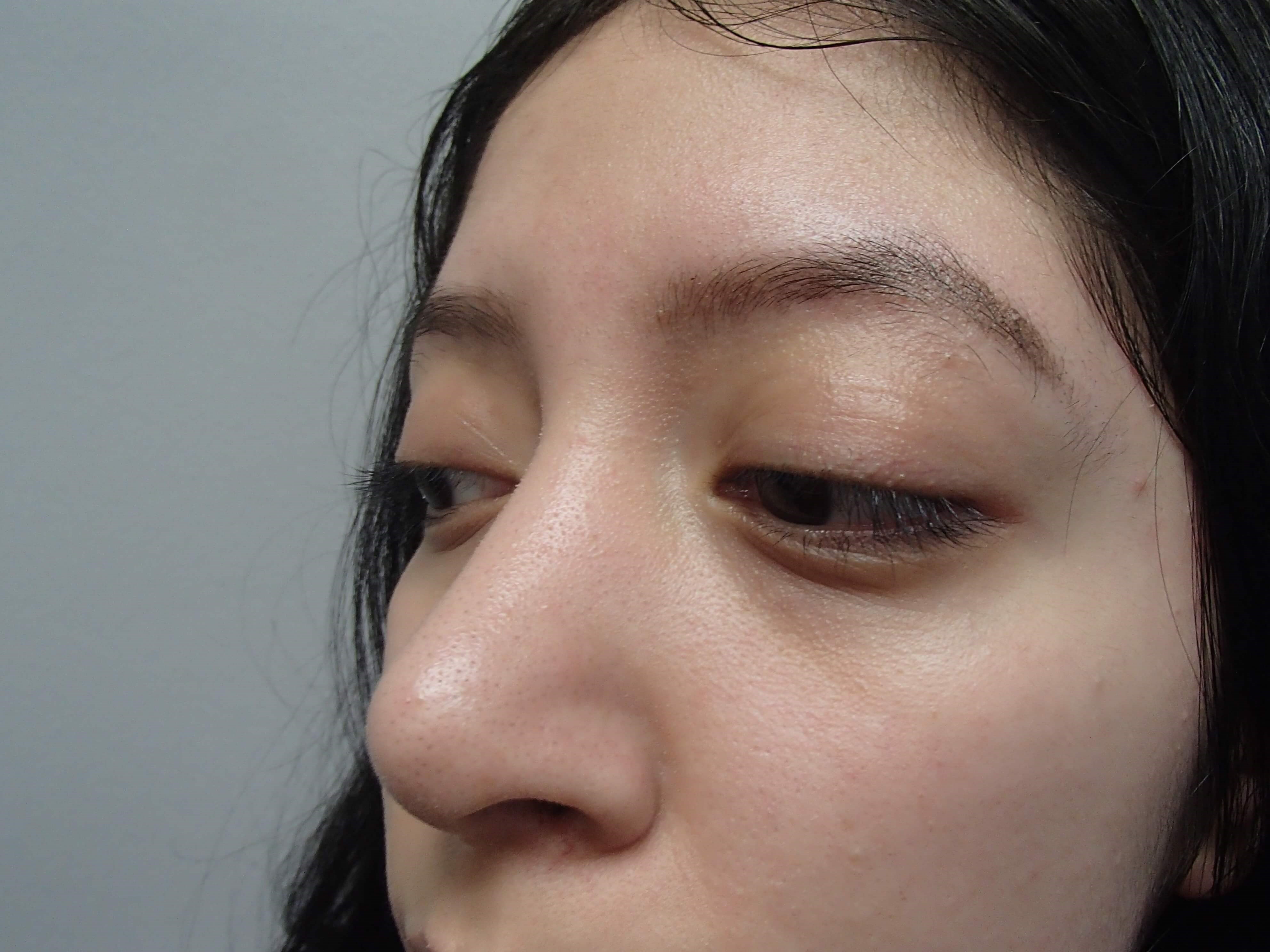 Rhinoplasty (Nose Job) After