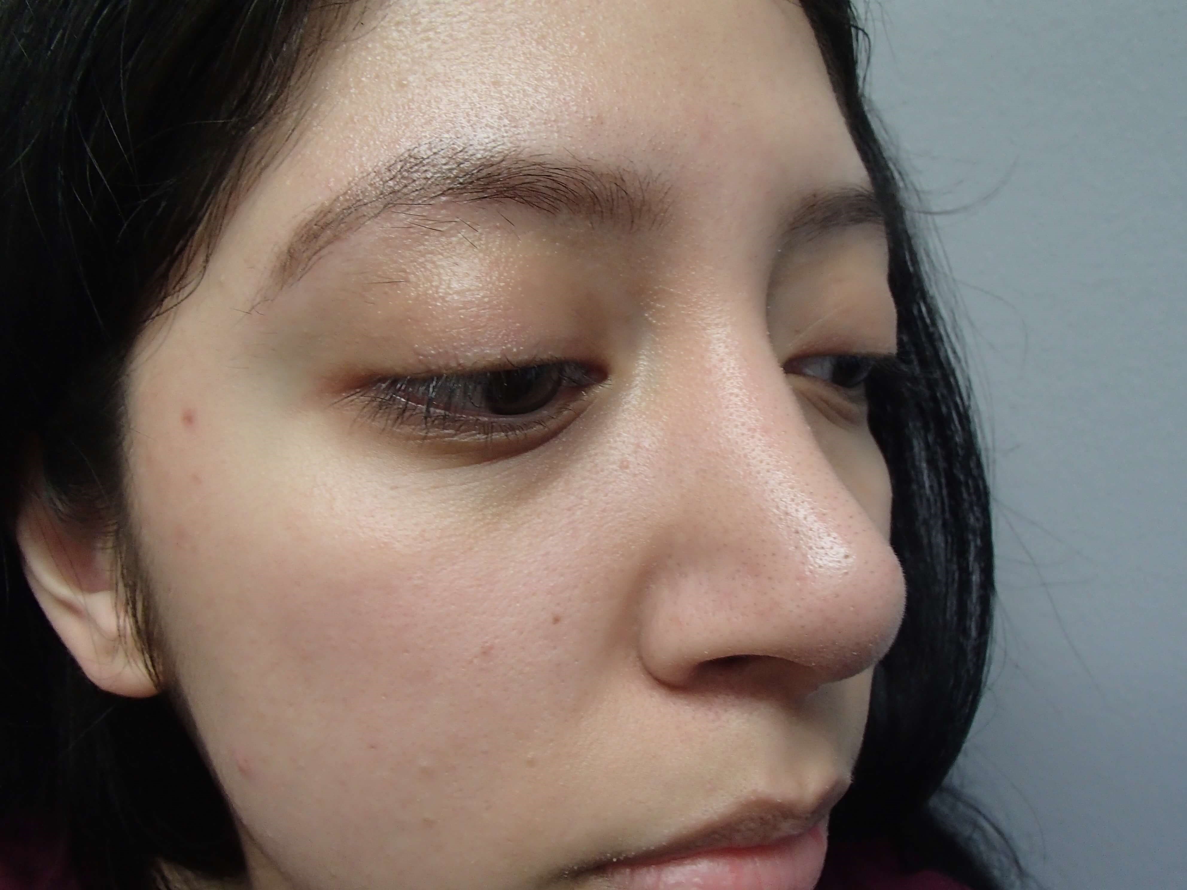 Rhinoplasty (Nose Job) After