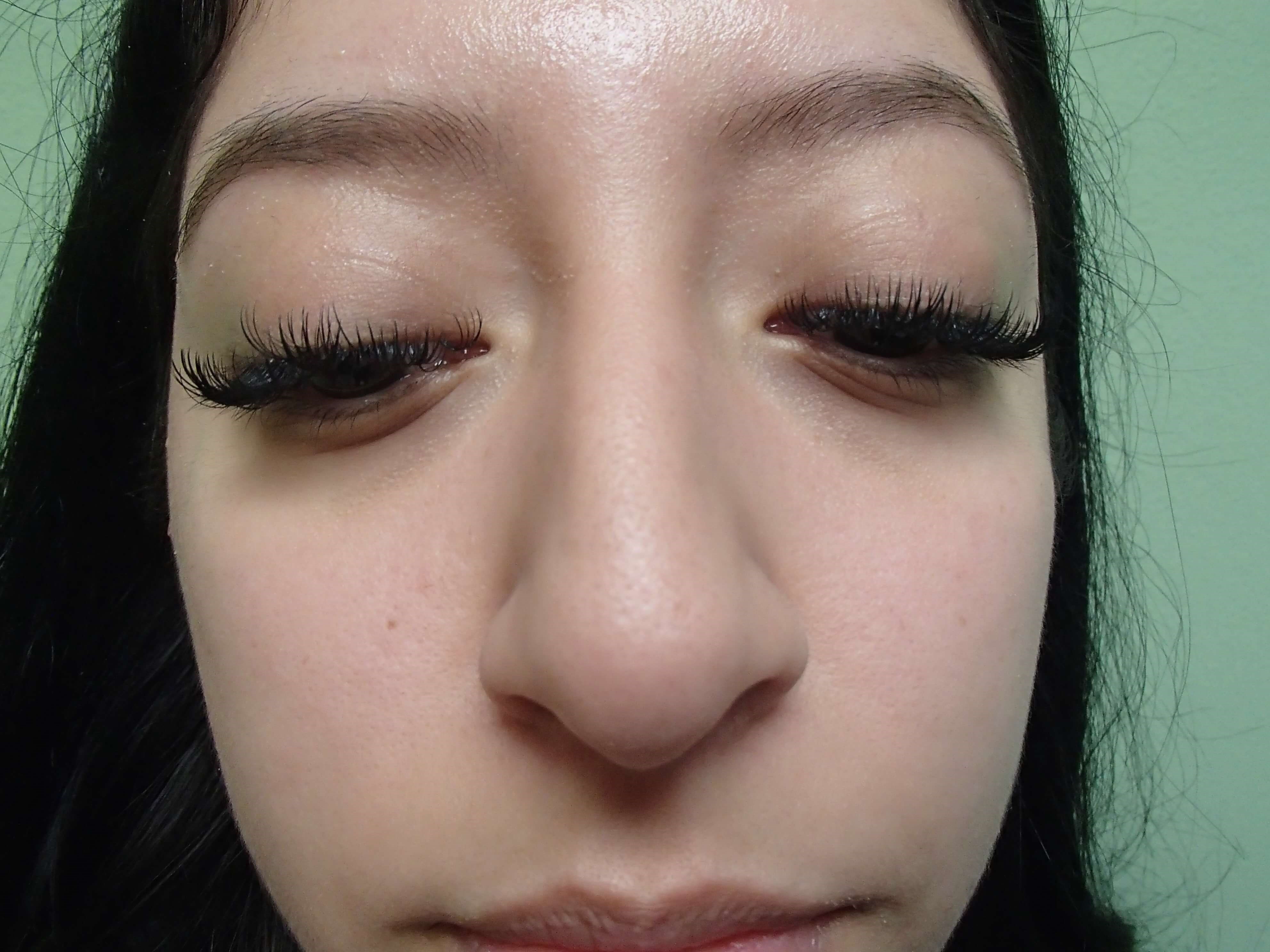 Rhinoplasty (Nose Job) Before