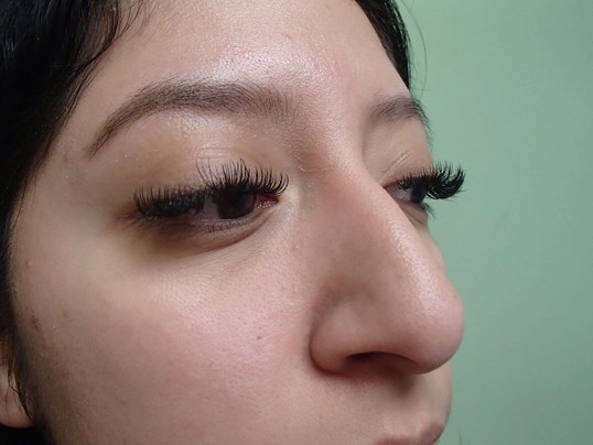Rhinoplasty (Nose Job) Before