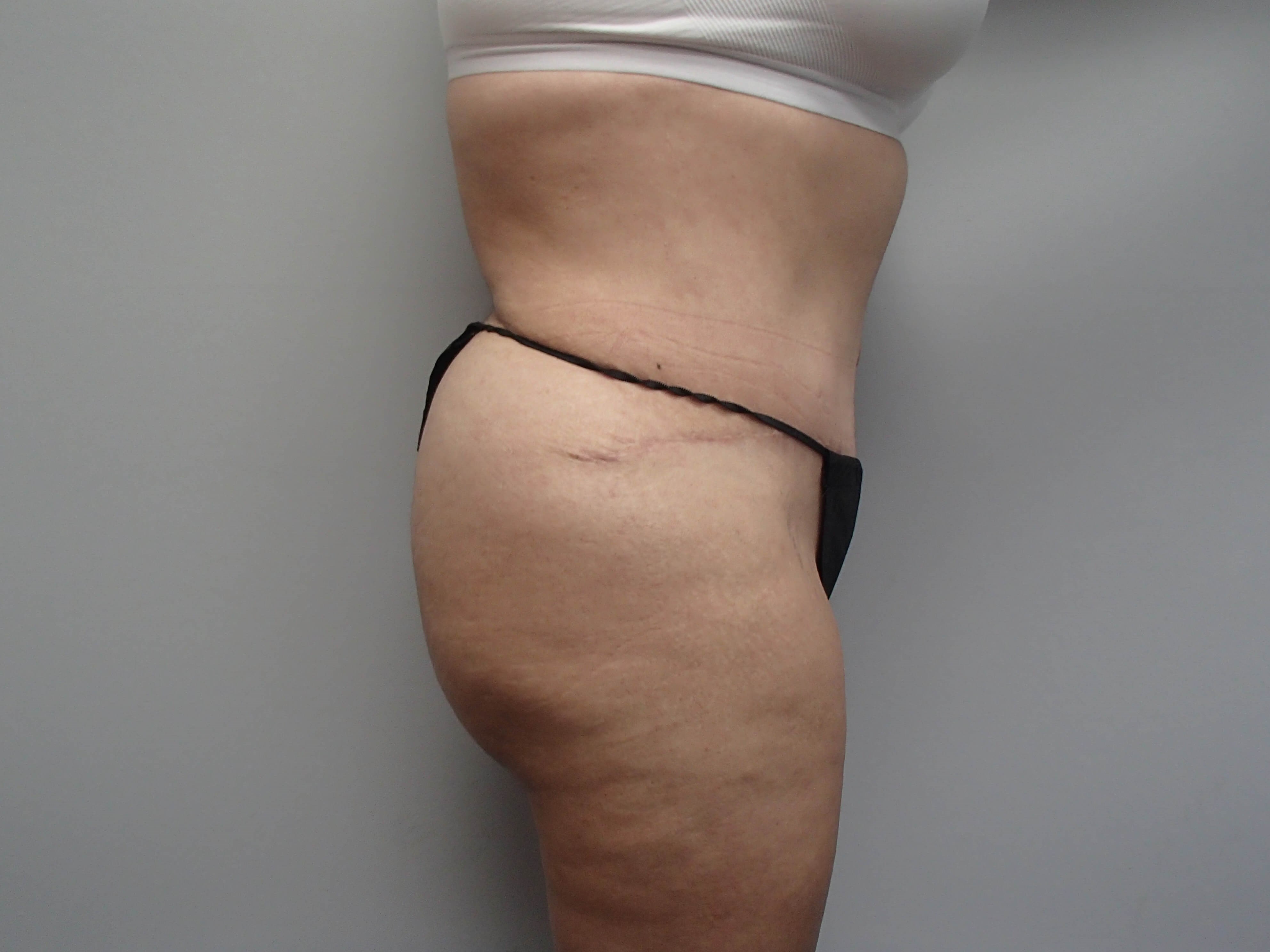 Revision Tummy Tuck After