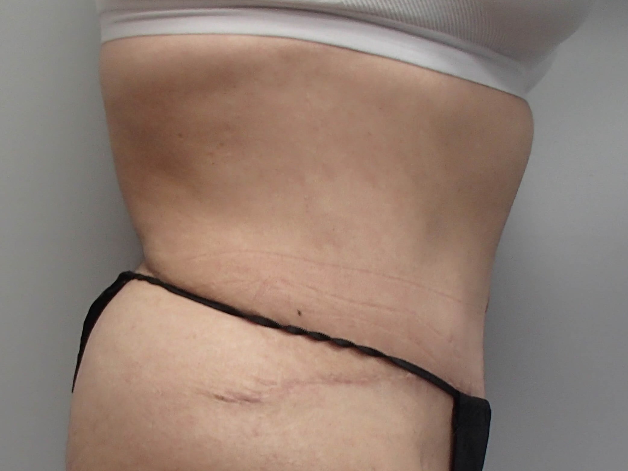 Revision Tummy Tuck After