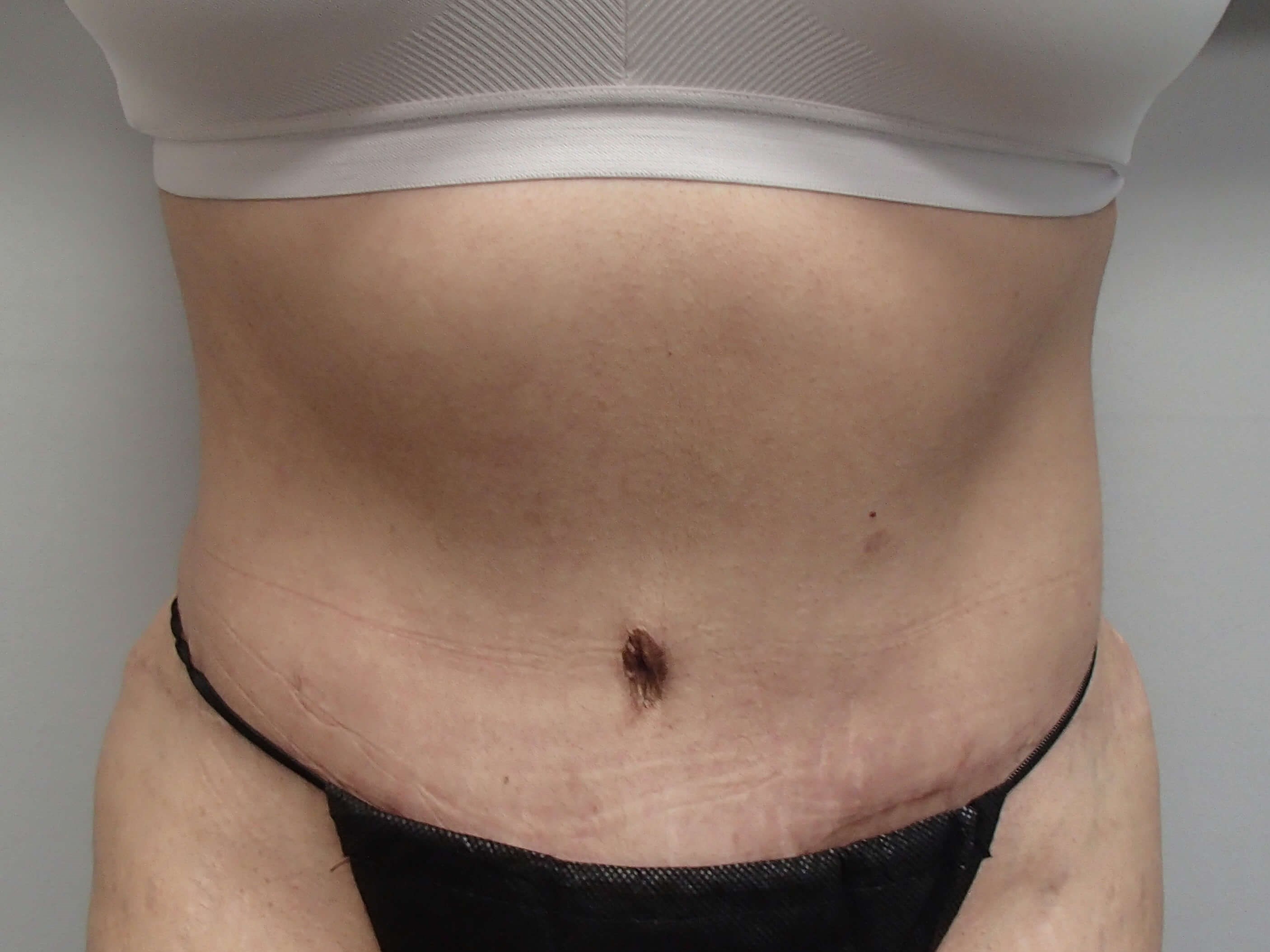 Revision Tummy Tuck After