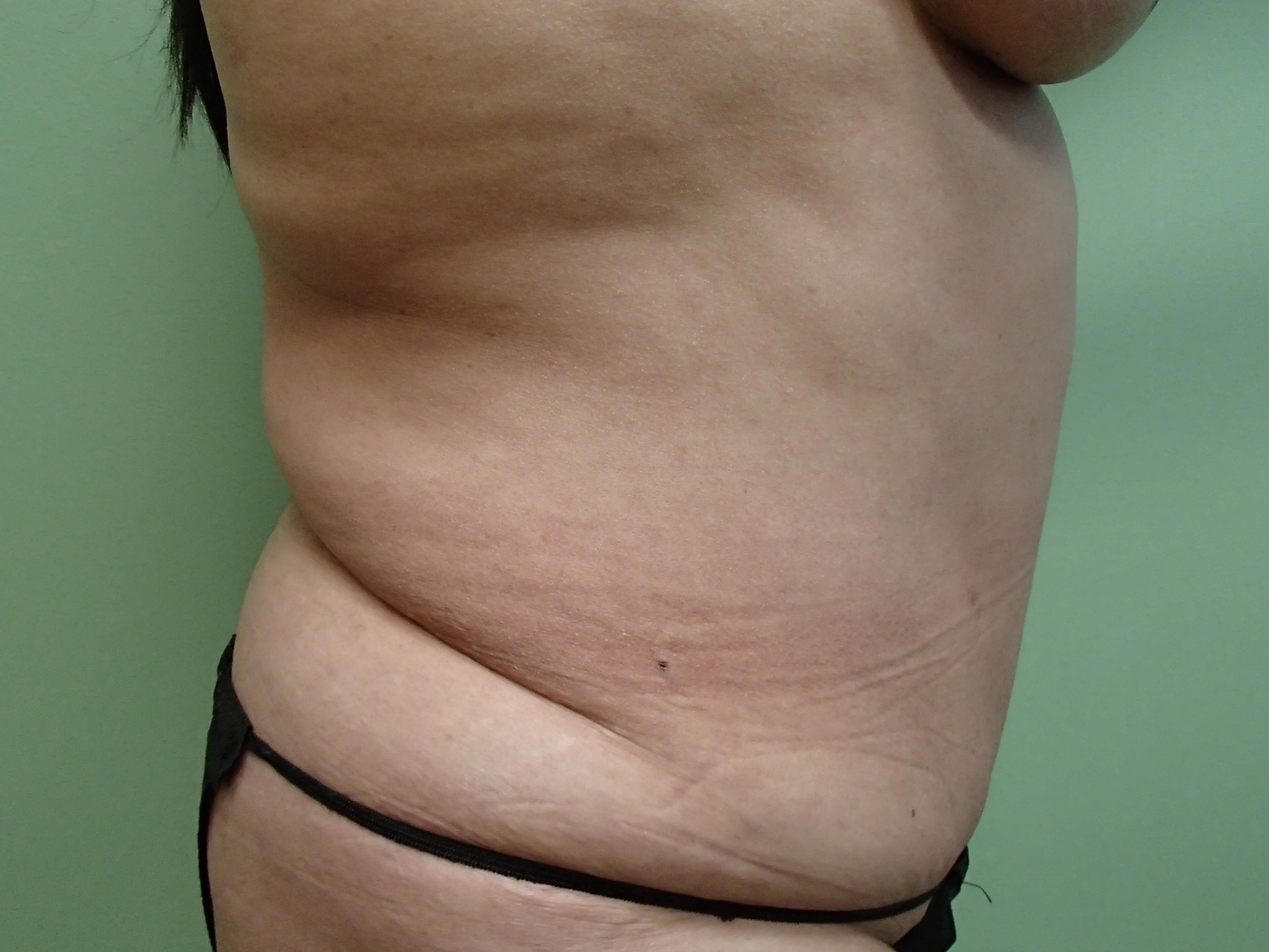 Revision Tummy Tuck Before