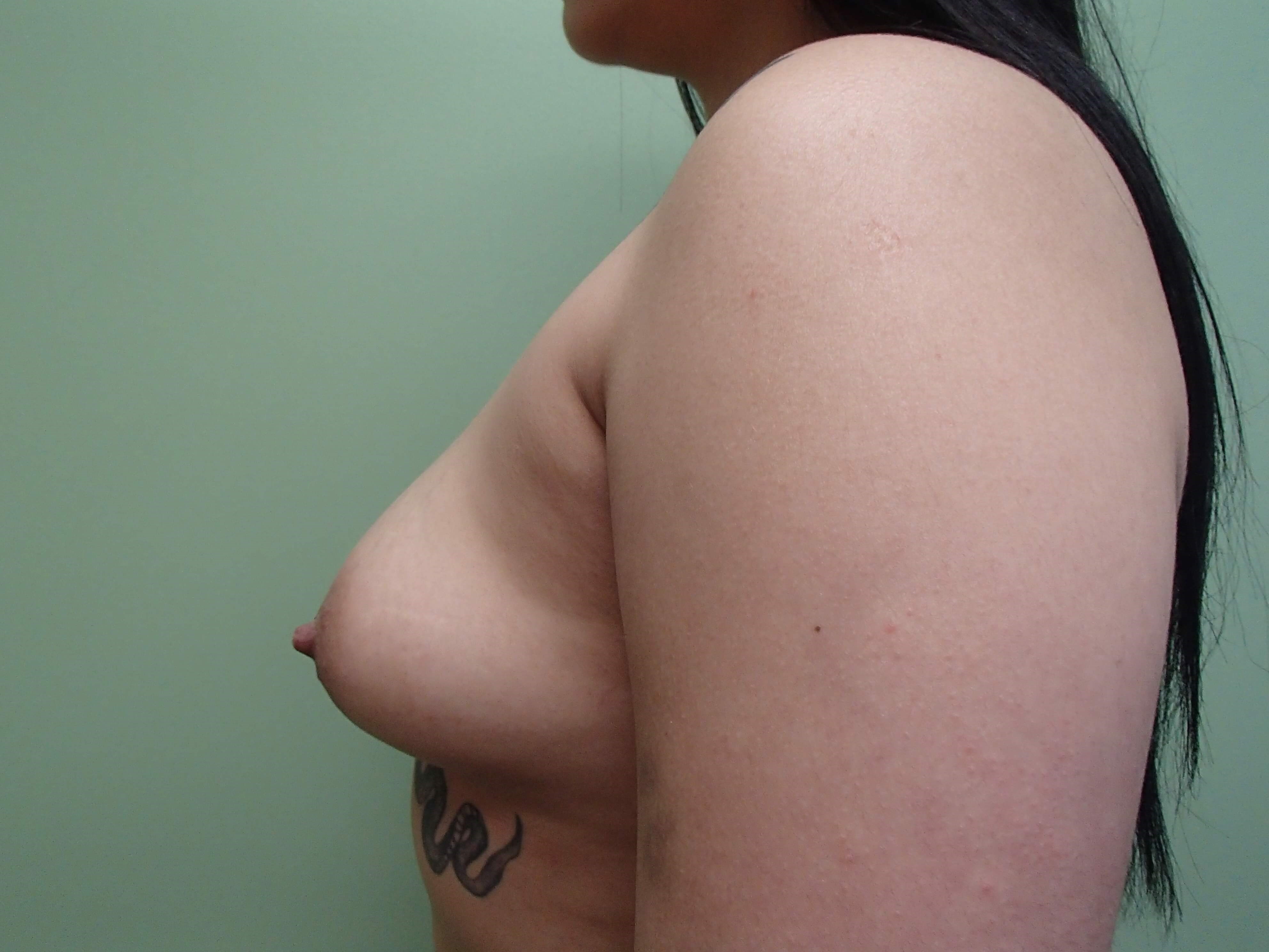Breast Augmentation Before