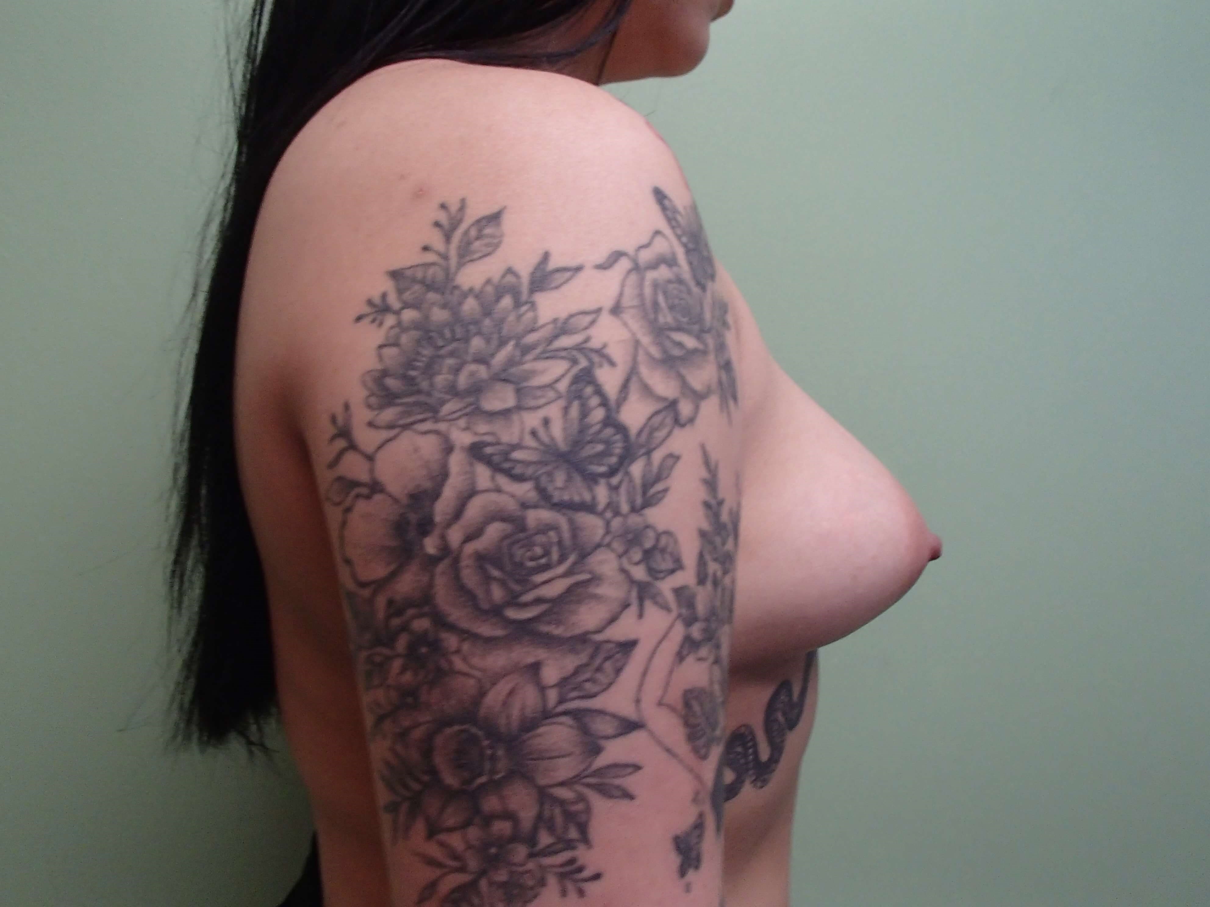 Breast Augmentation Before