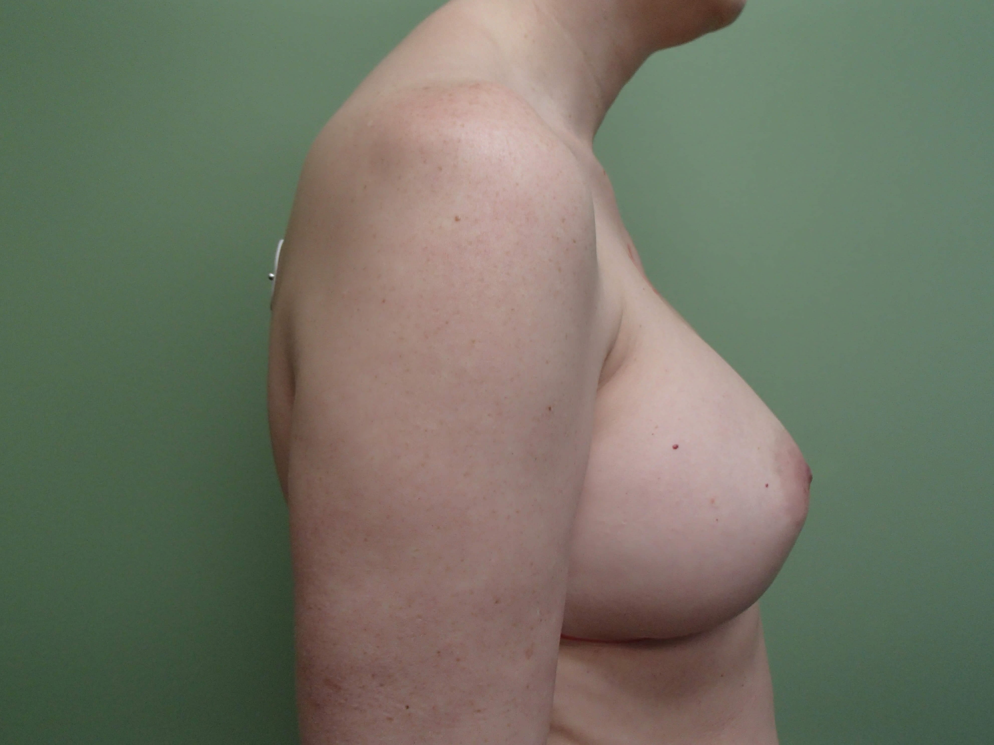Breast Revision Before