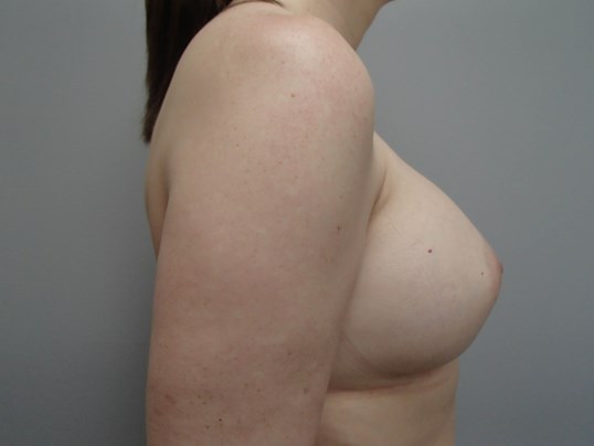 Breast Revision After