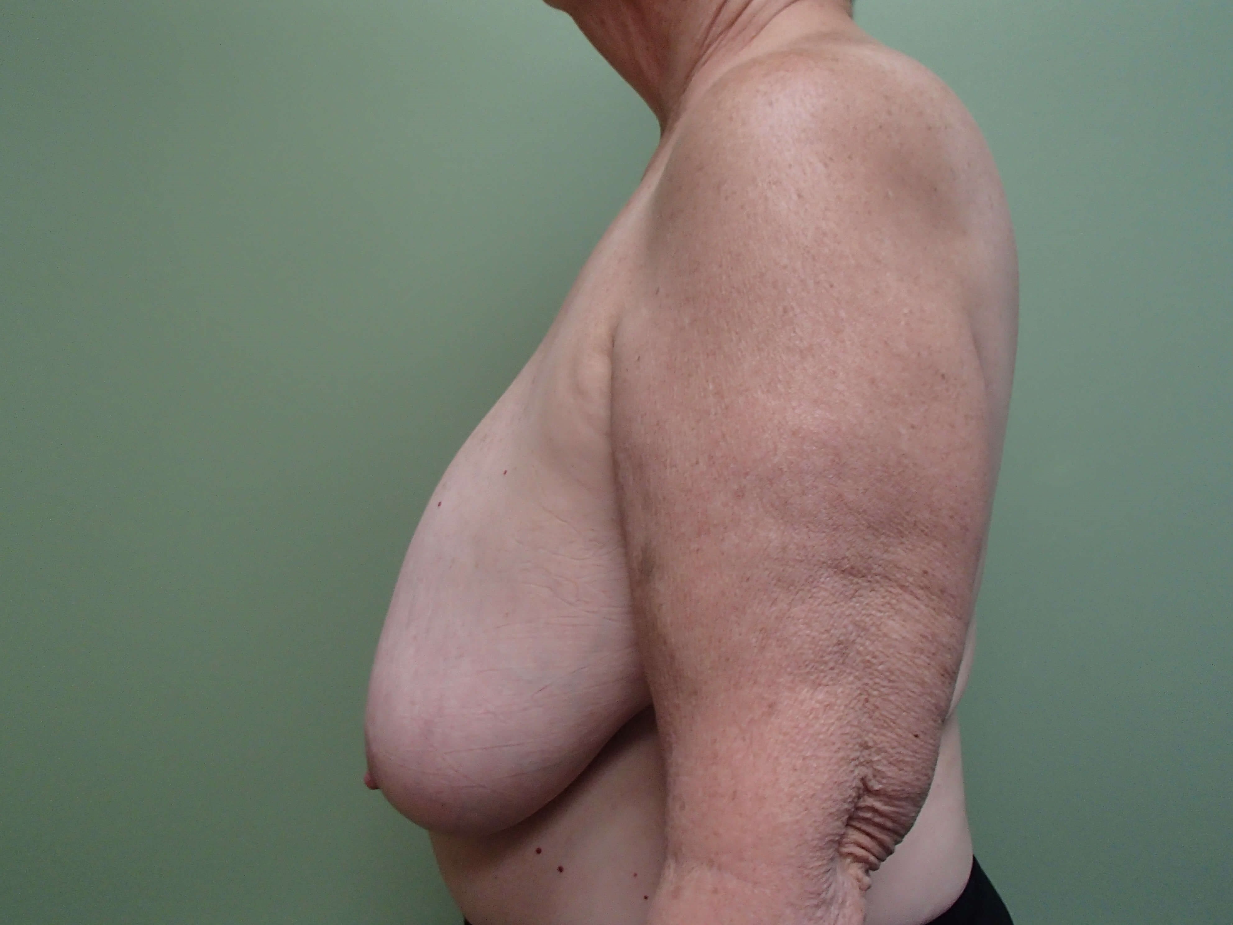 Breast Reduction Before