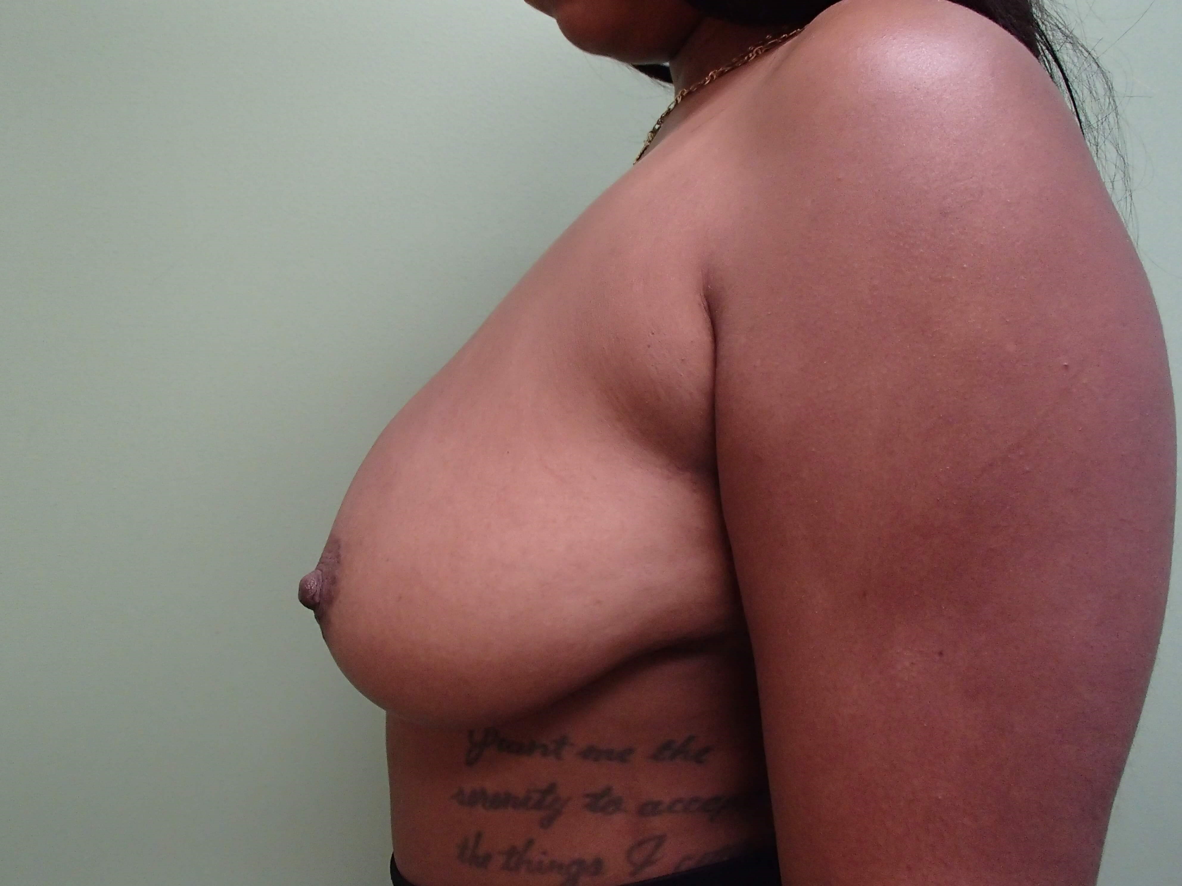 Breast Lift WITH Implants Before