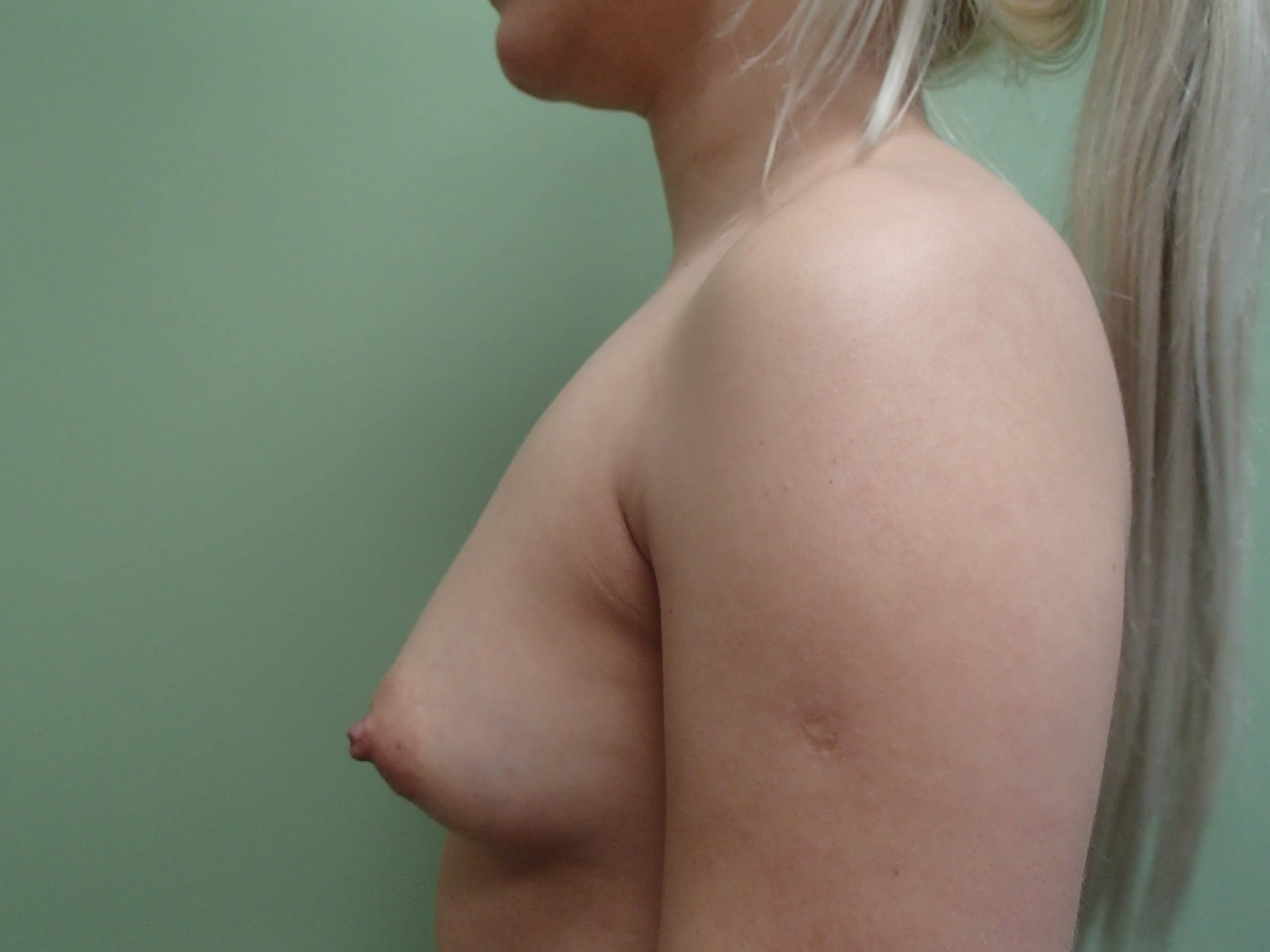 Breast Augmentation Before