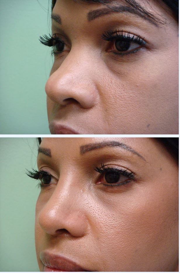 Rhinoplasty with Implant Before